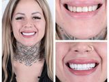 Hollywoodsmile-behandeling Turkije