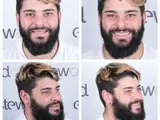 Hollywoodsmile-behandeling Turkije