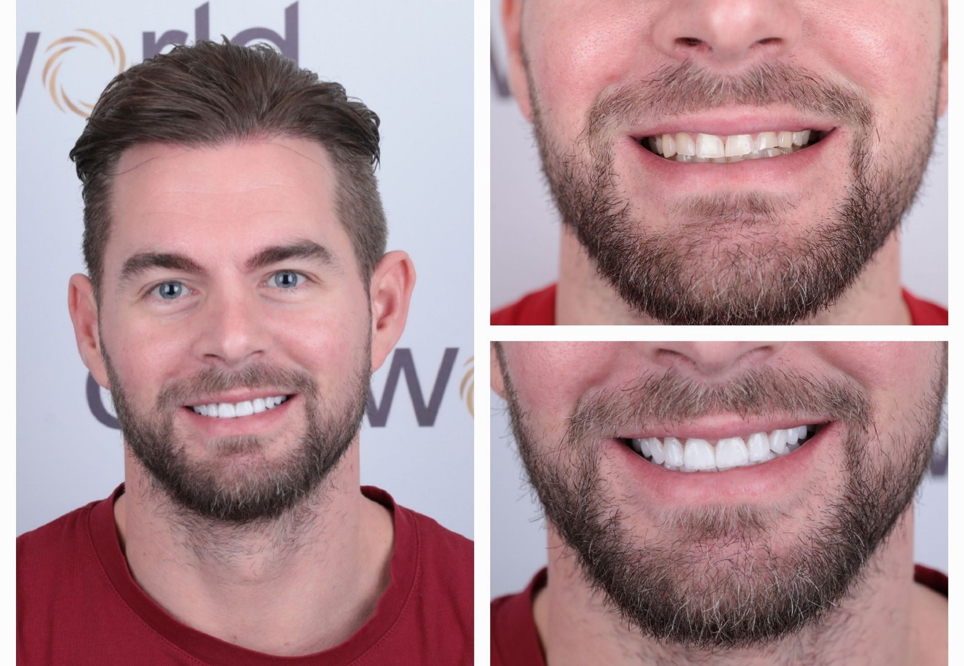 Marco,na succesvolle haartransplantatie nu naar de tandarts