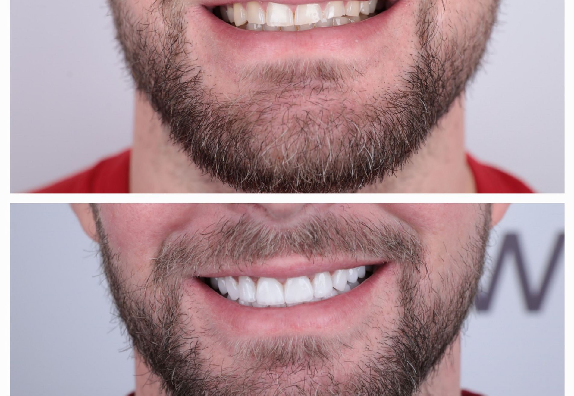 Marco,na succesvolle haartransplantatie nu naar de tandarts