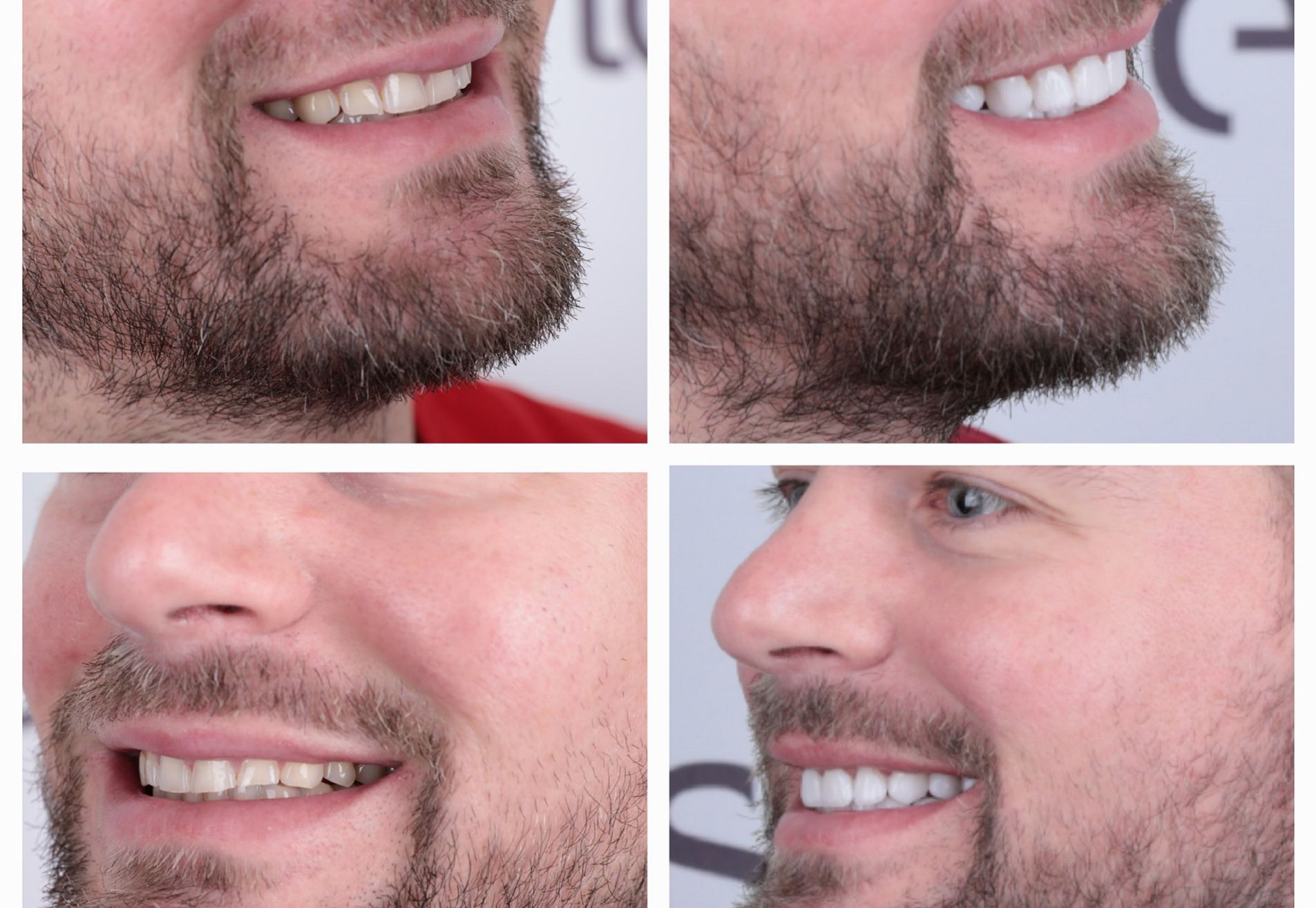 Marco,na succesvolle haartransplantatie nu naar de tandarts