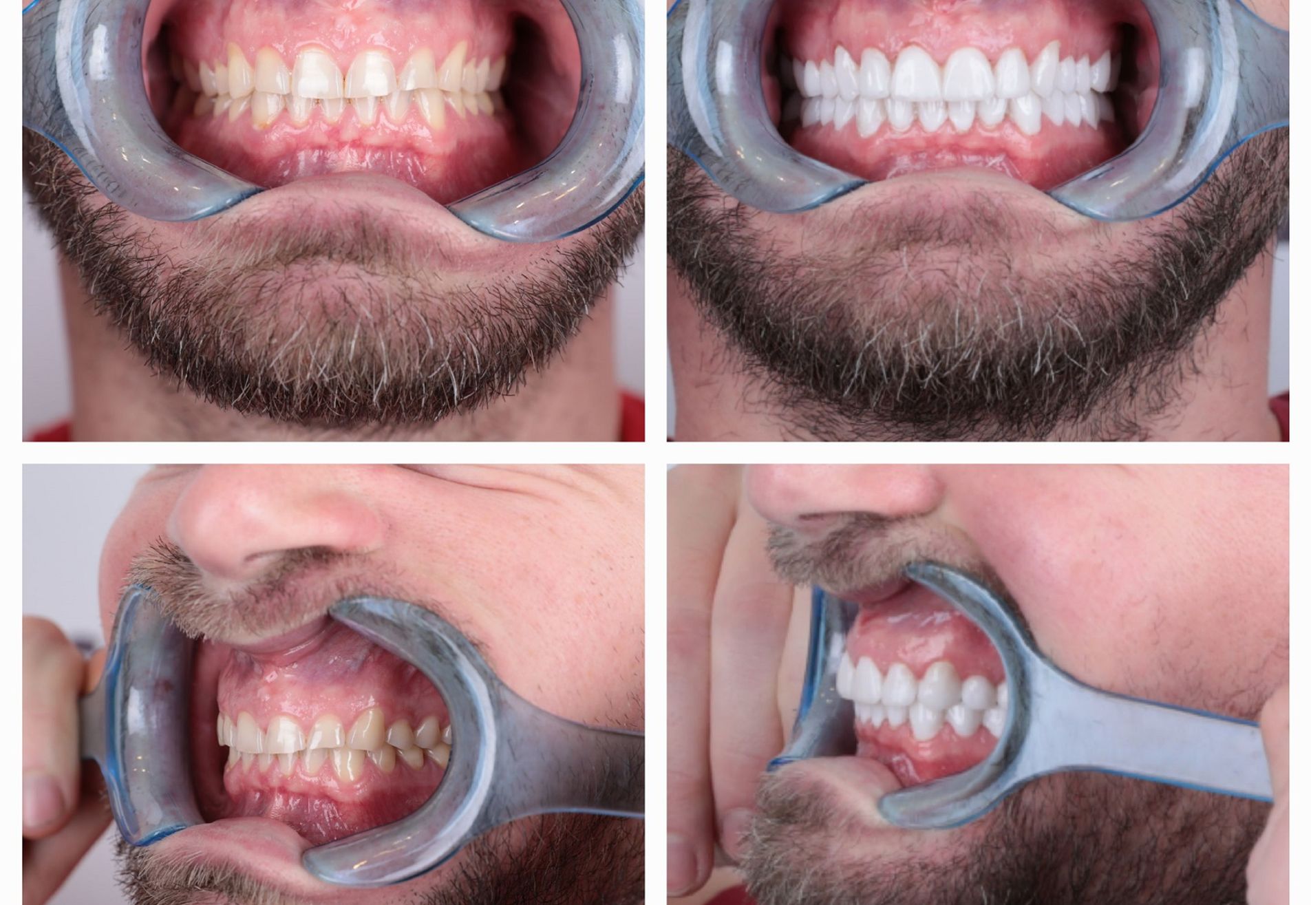 Marco,na succesvolle haartransplantatie nu naar de tandarts