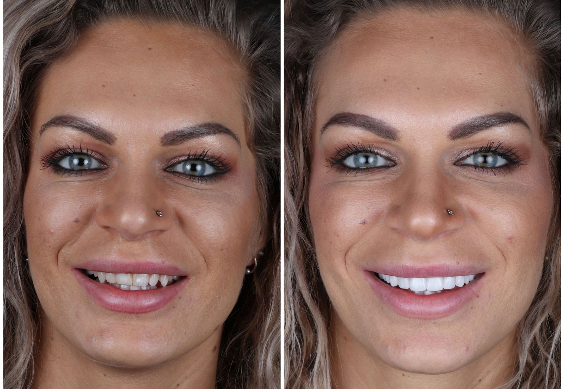 @eveliennellen door eetstoornis slecht gebit