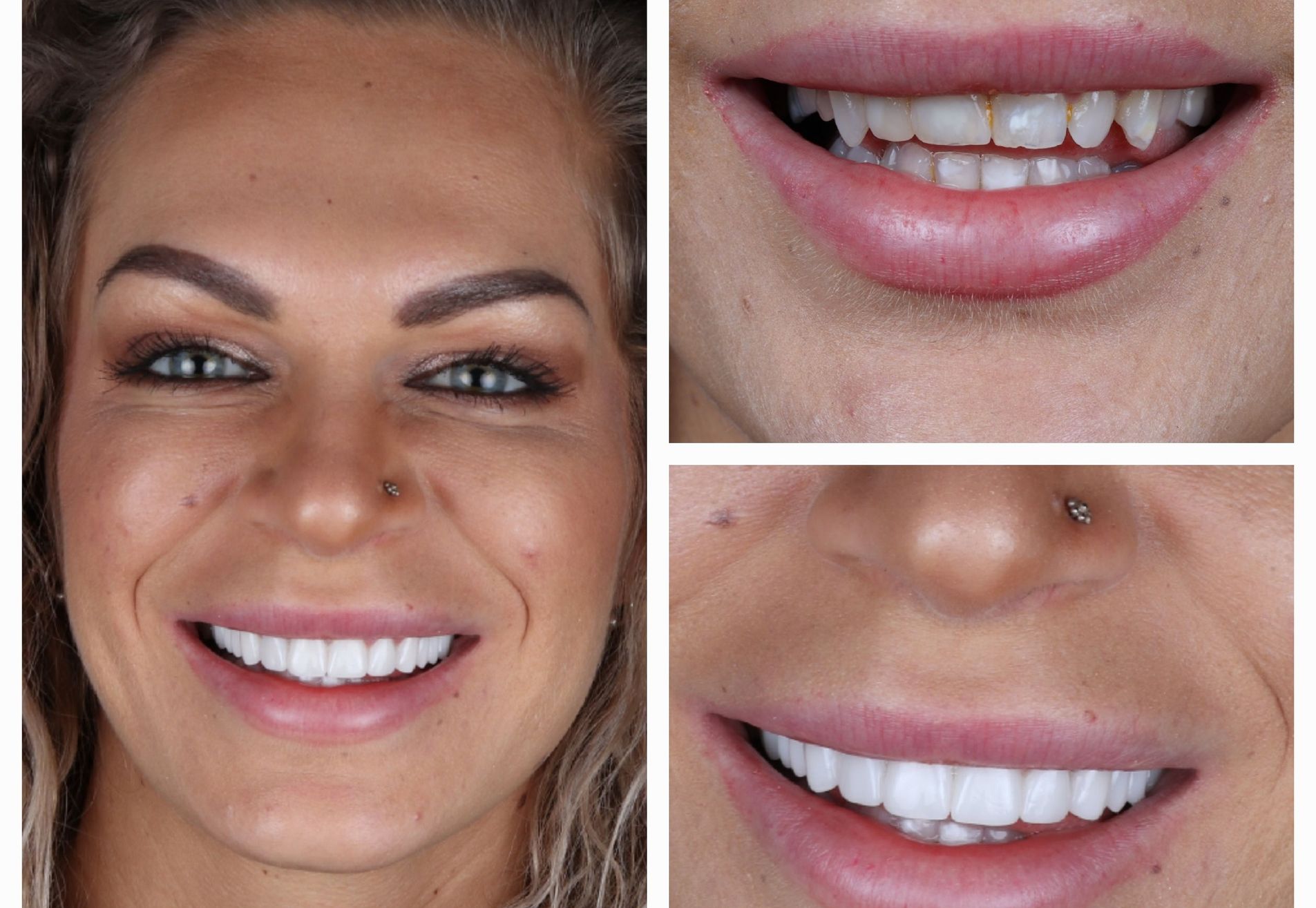 @eveliennellen door eetstoornis slecht gebit