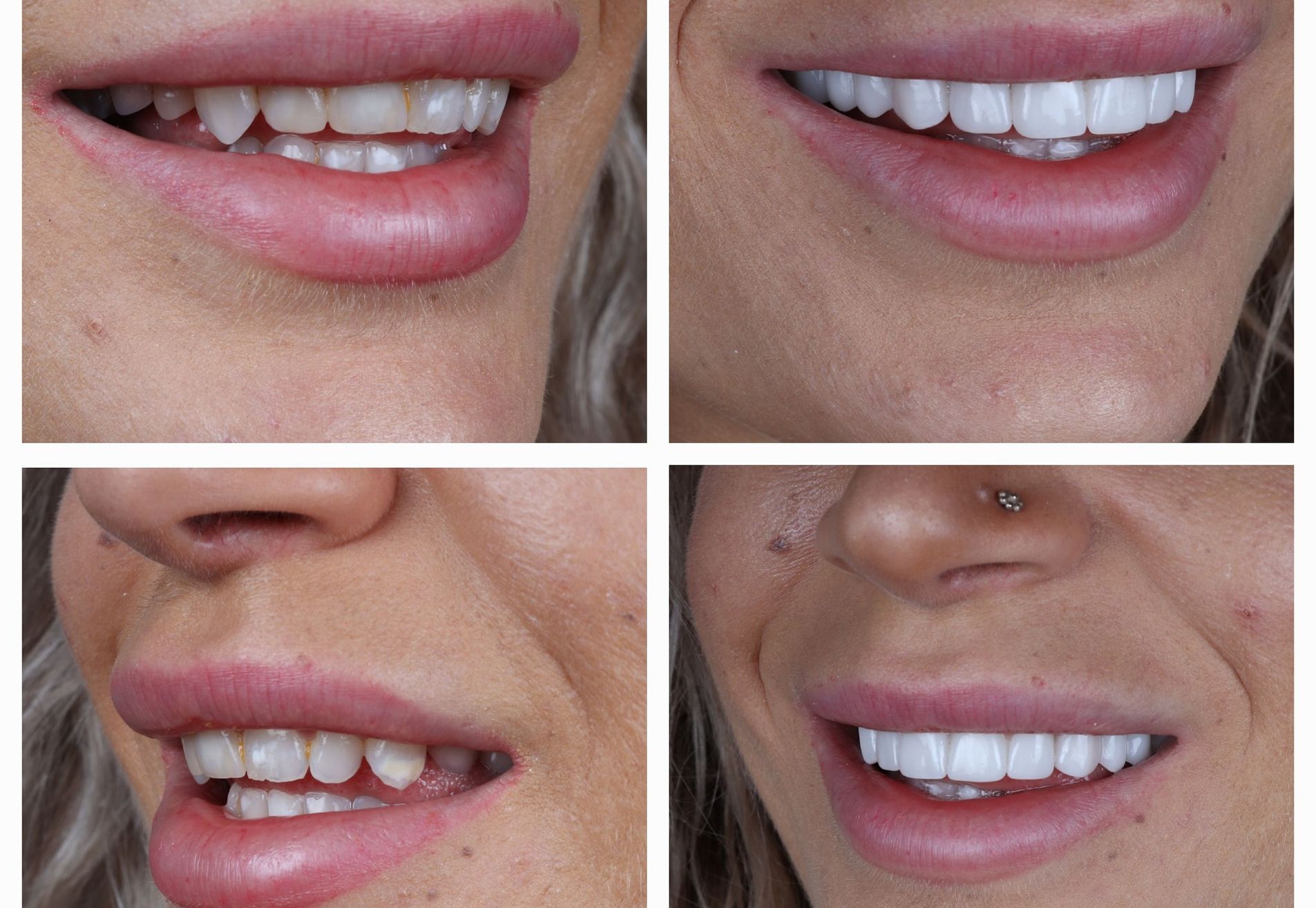 @eveliennellen door eetstoornis slecht gebit