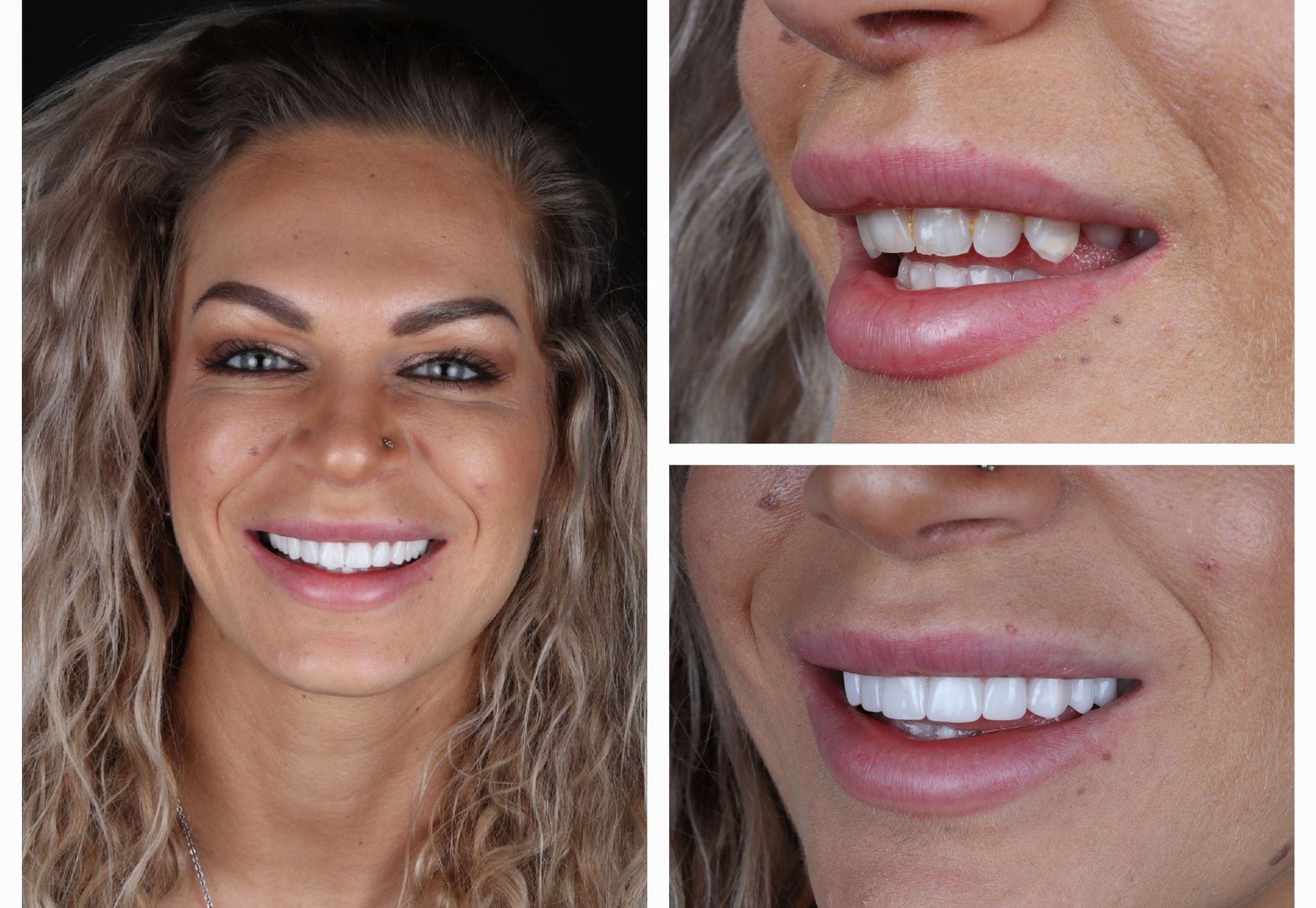 @eveliennellen door eetstoornis slecht gebit