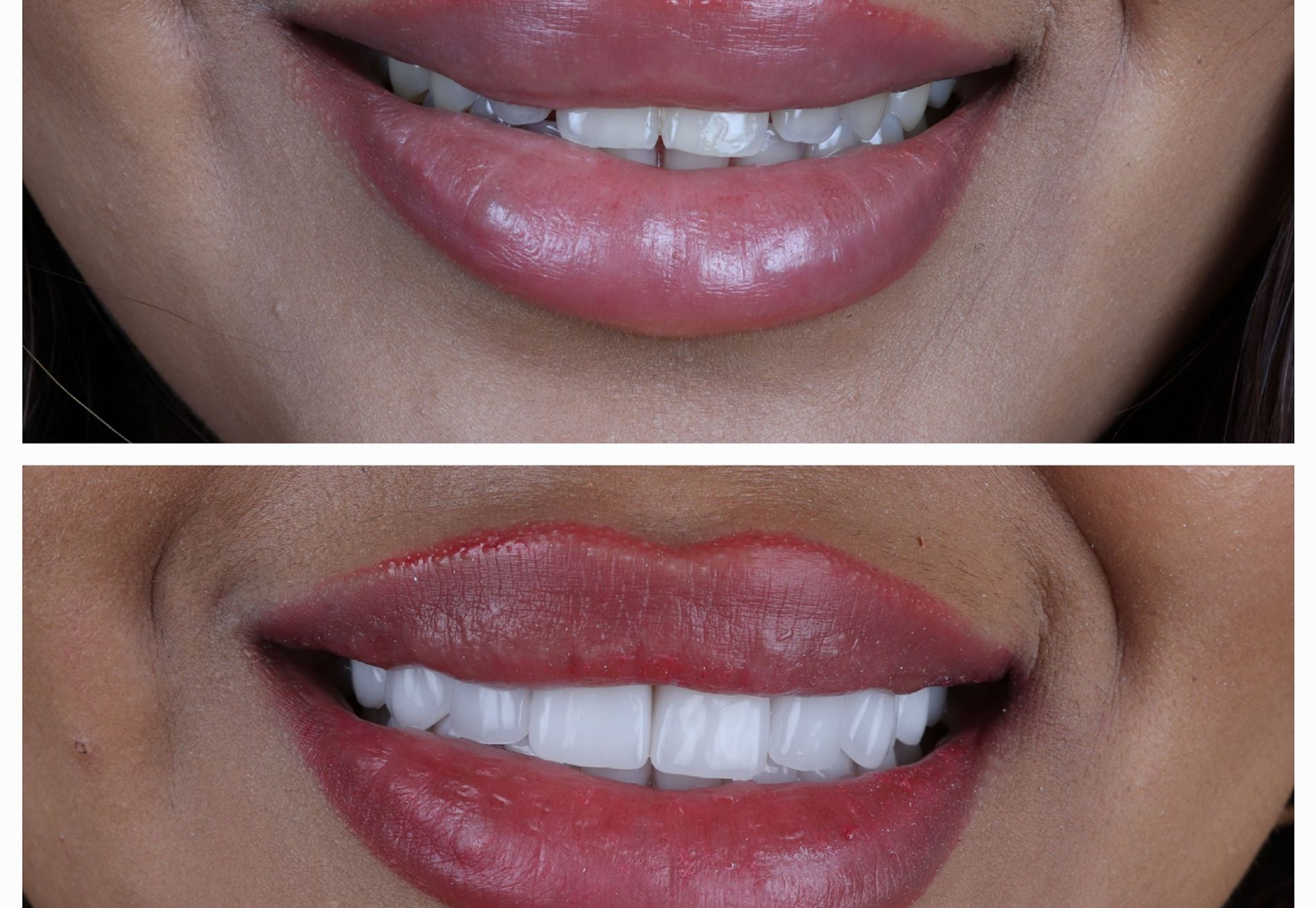 Dubai Vlogger voor kronen en Facings naar Esteworld