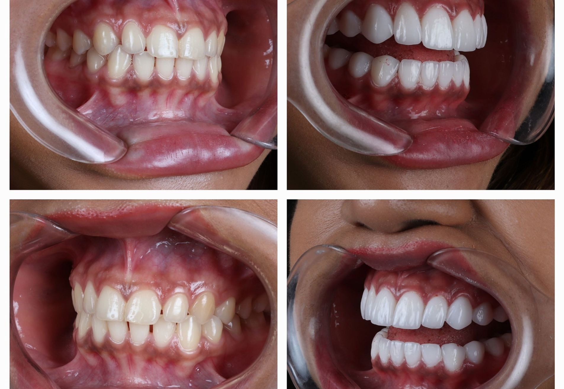 Dubai Vlogger voor kronen en Facings naar Esteworld