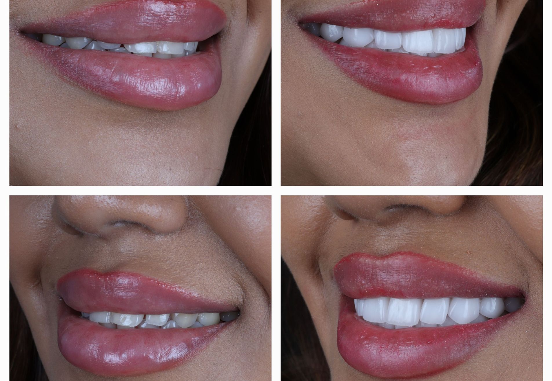 Dubai Vlogger voor kronen en Facings naar Esteworld