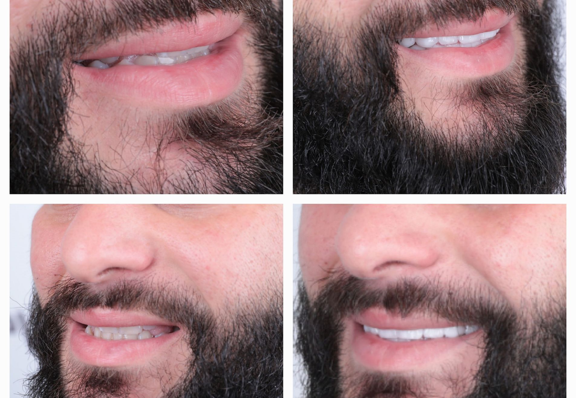 Sylvester kronen boven en onder