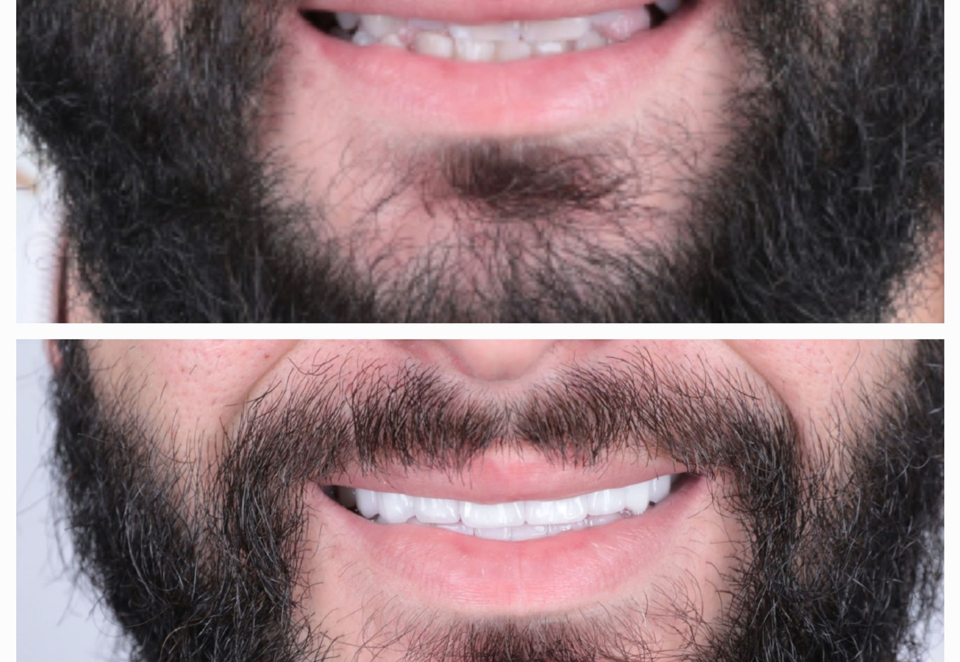 Sylvester kronen boven en onder