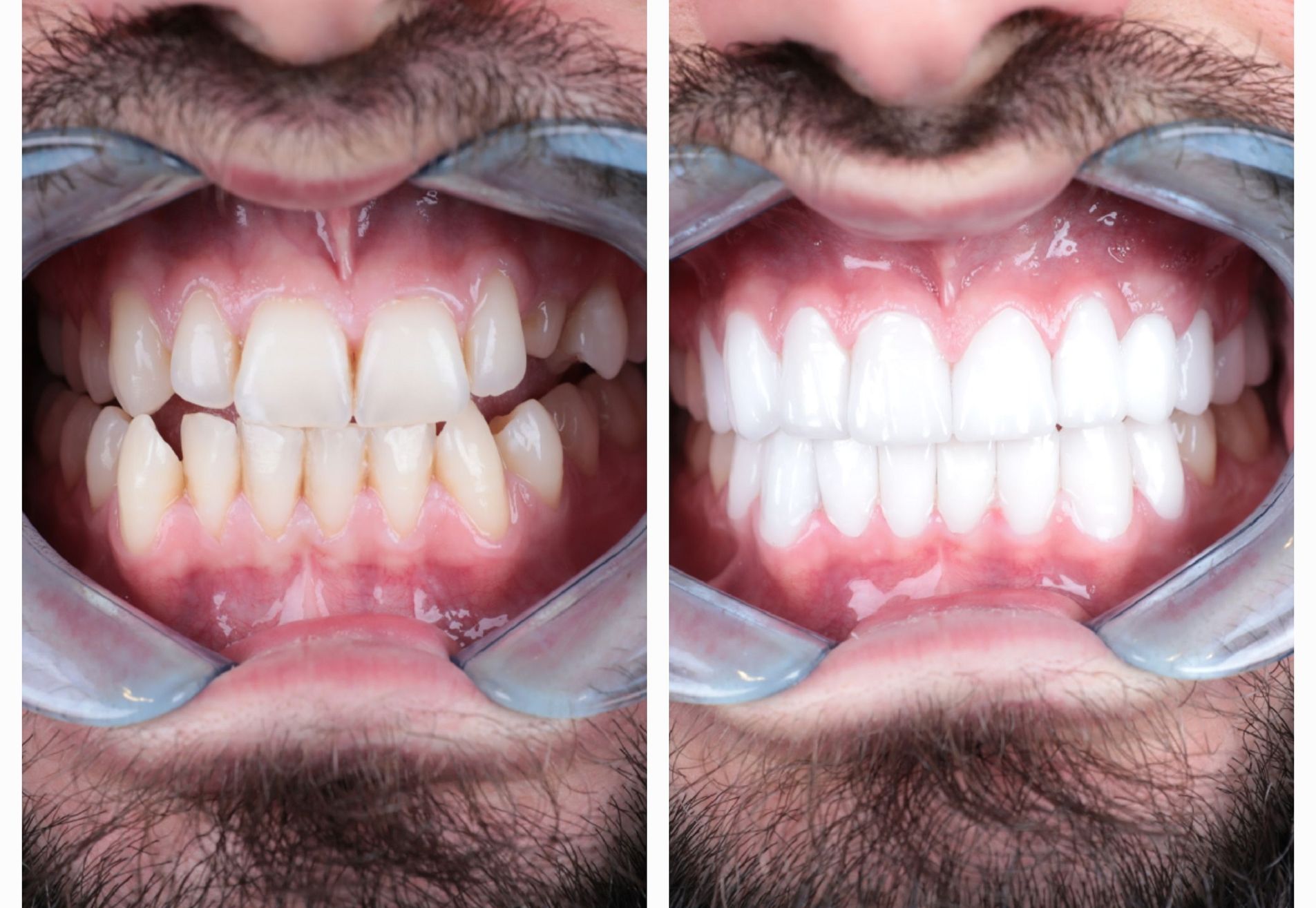 Sylvester kronen boven en onder