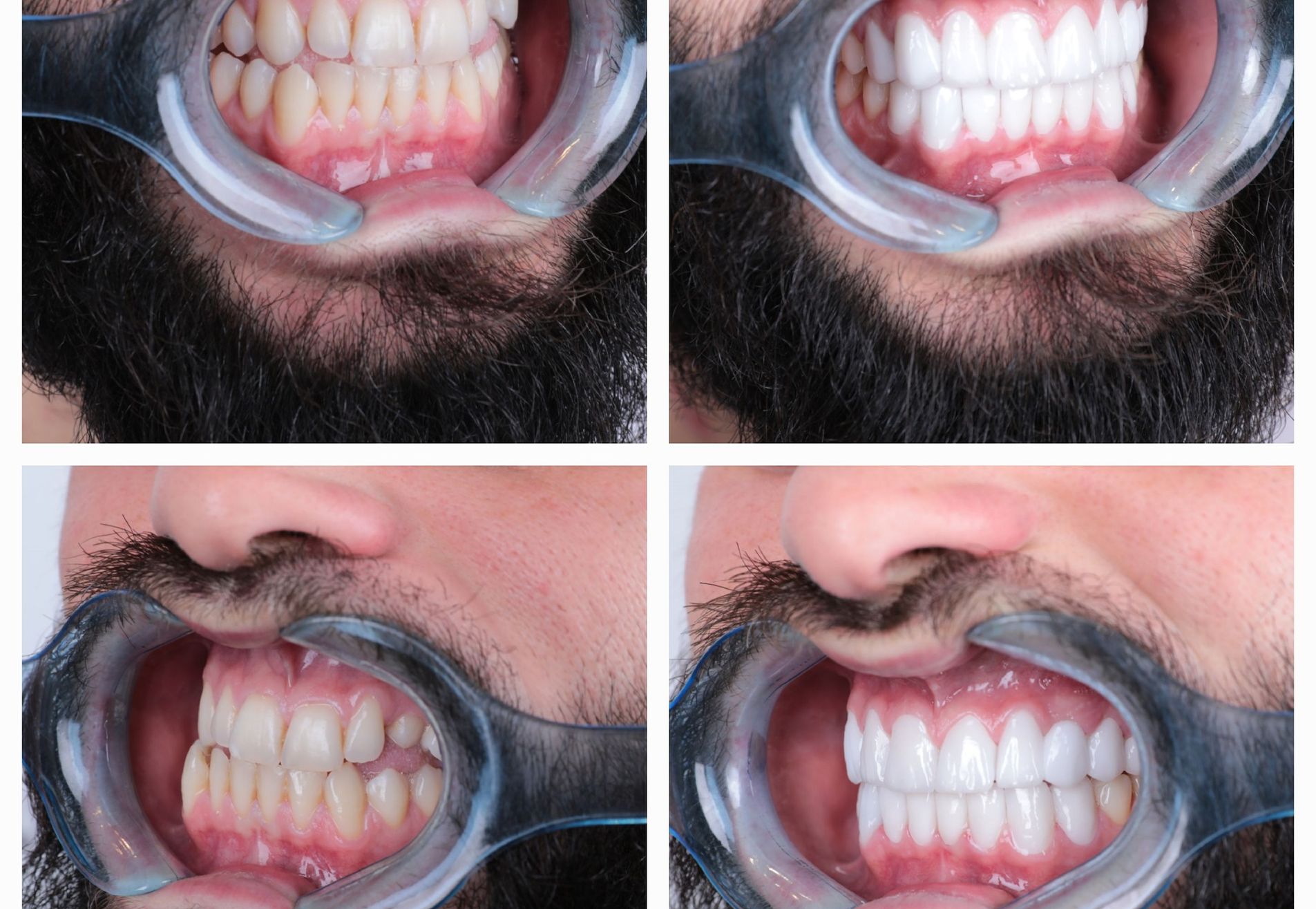 Sylvester kronen boven en onder