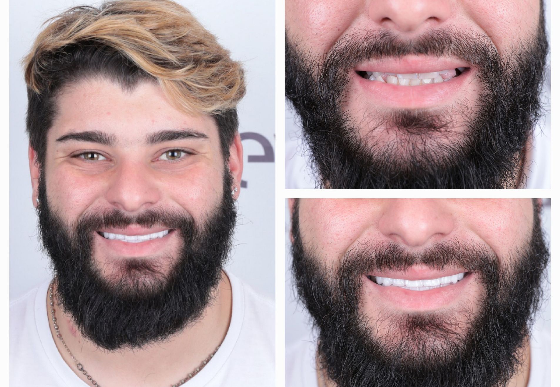 Sylvester kronen boven en onder