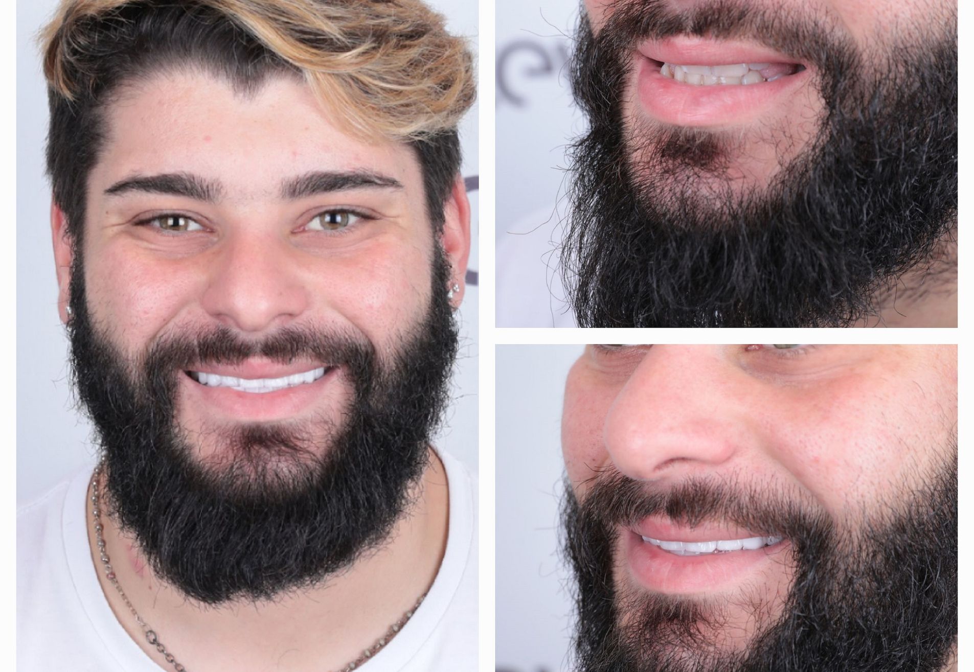 Sylvester kronen boven en onder