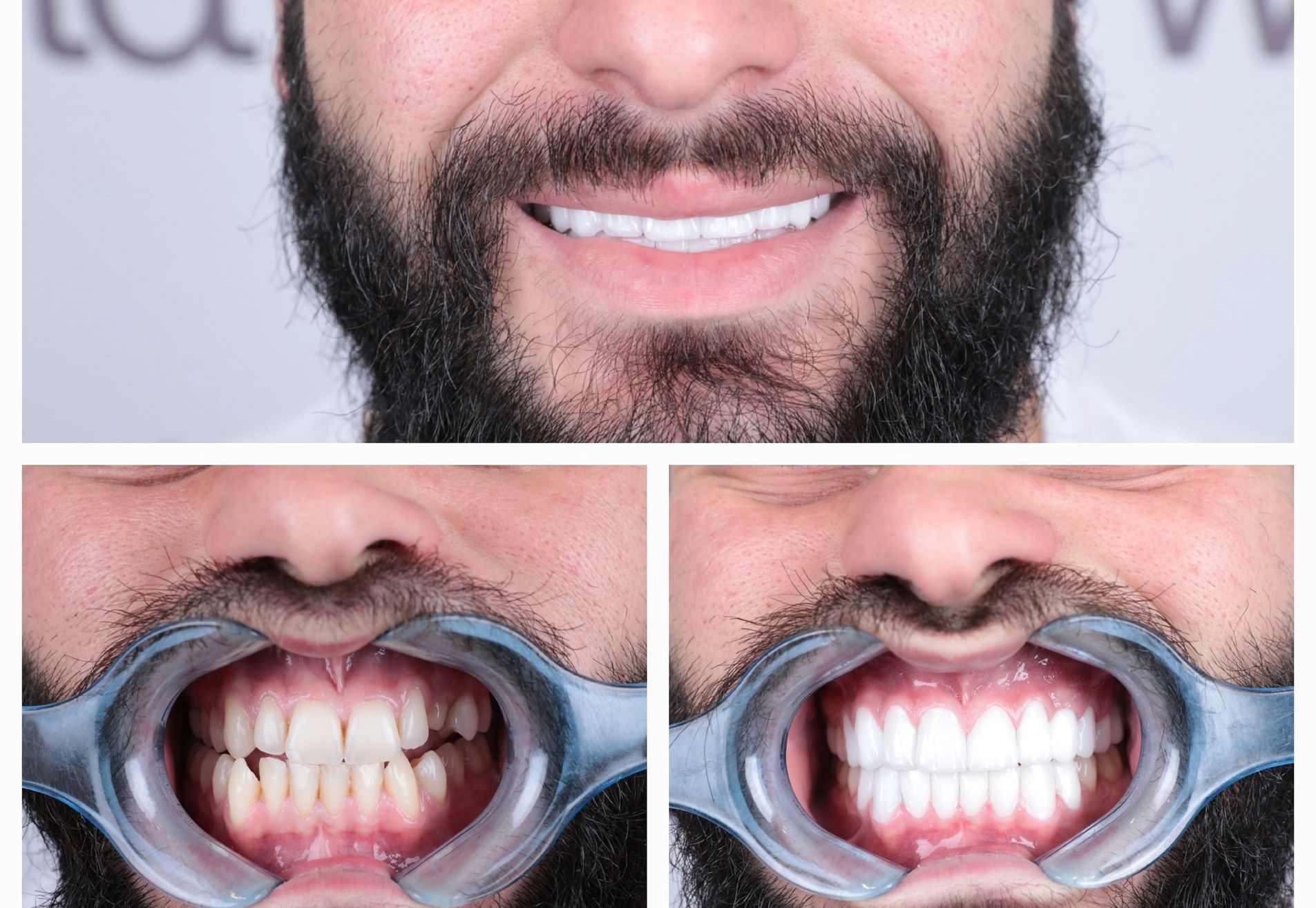 Sylvester kronen boven en onder