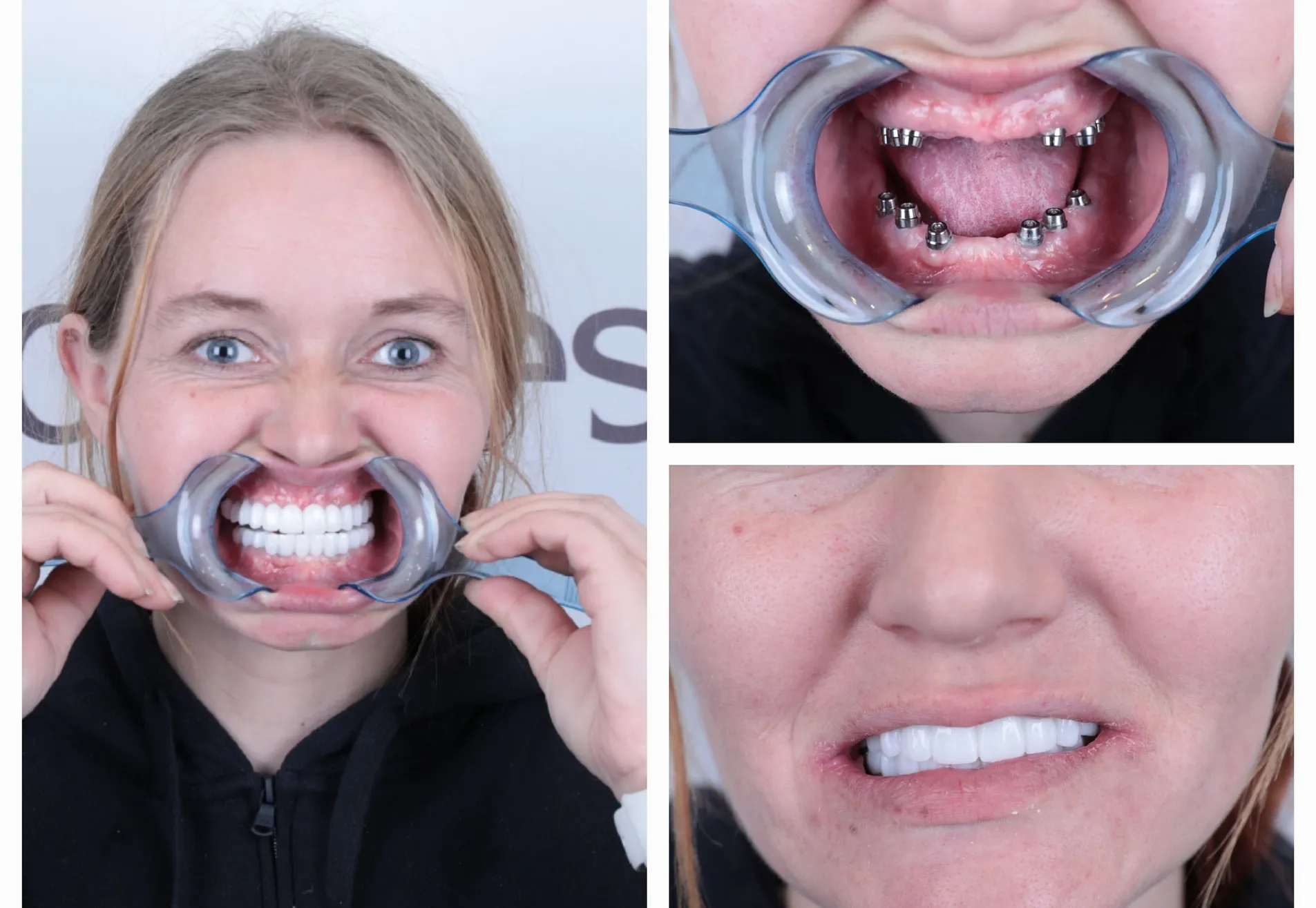 Anne implantaten en kronen all on 6 