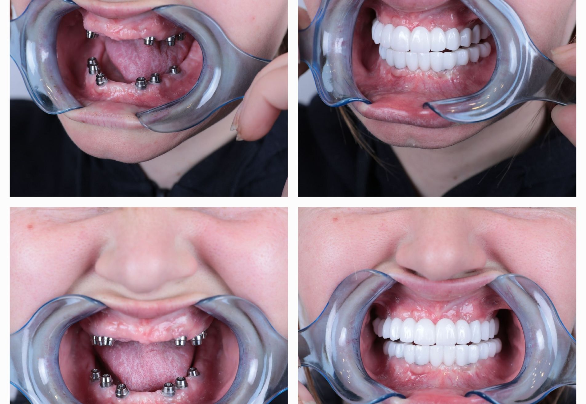 Anne implantaten en kronen all on 6 