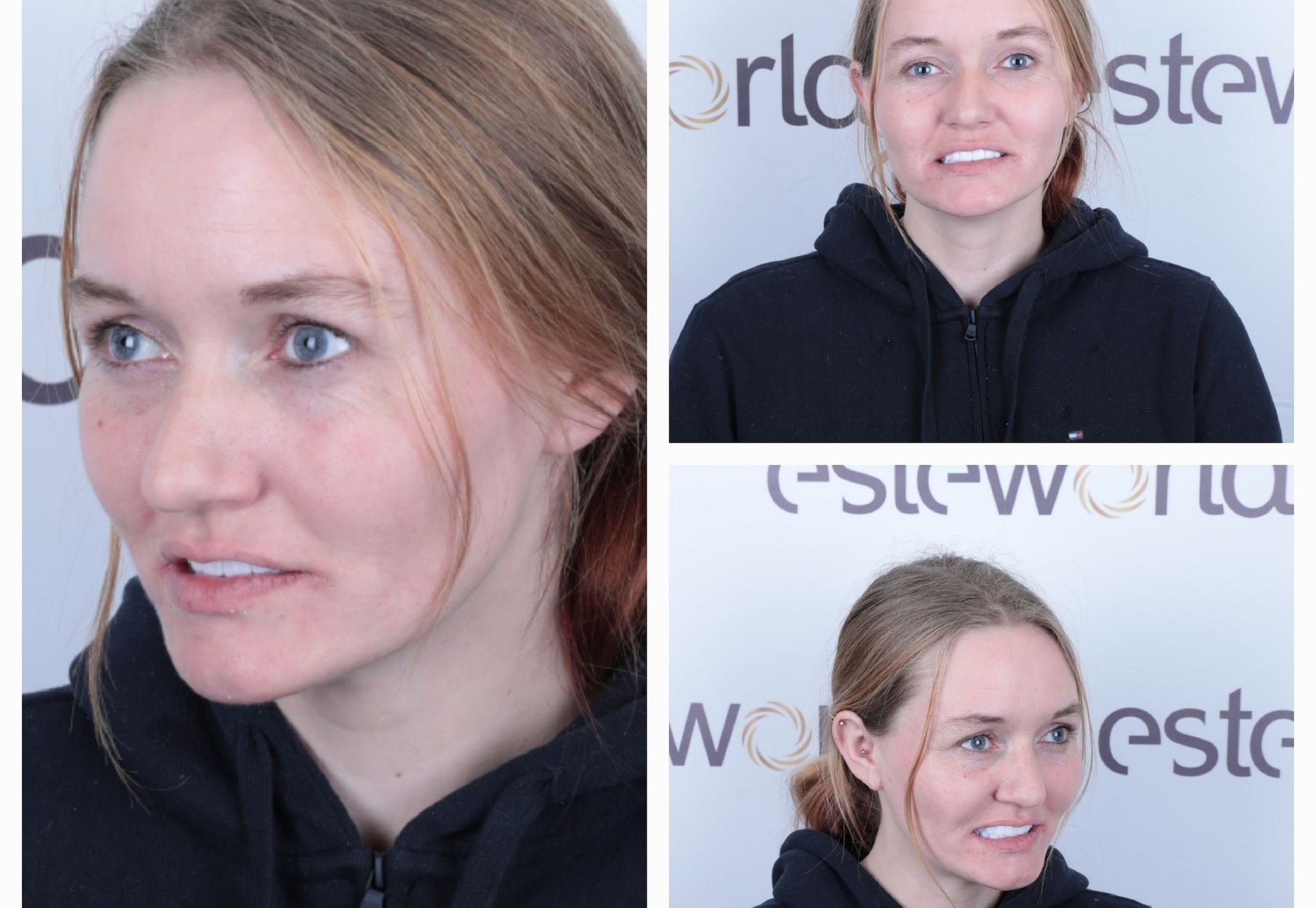 Anne implantaten en kronen all on 6 