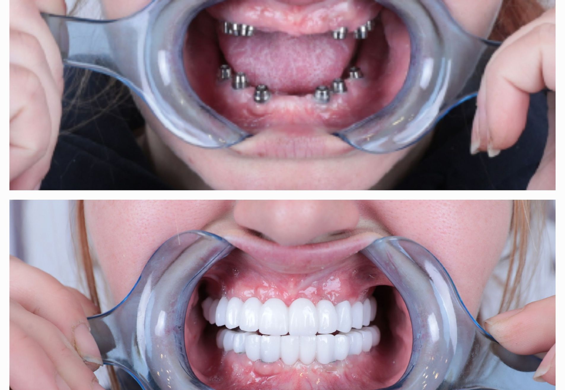 Anne implantaten en kronen all on 6 