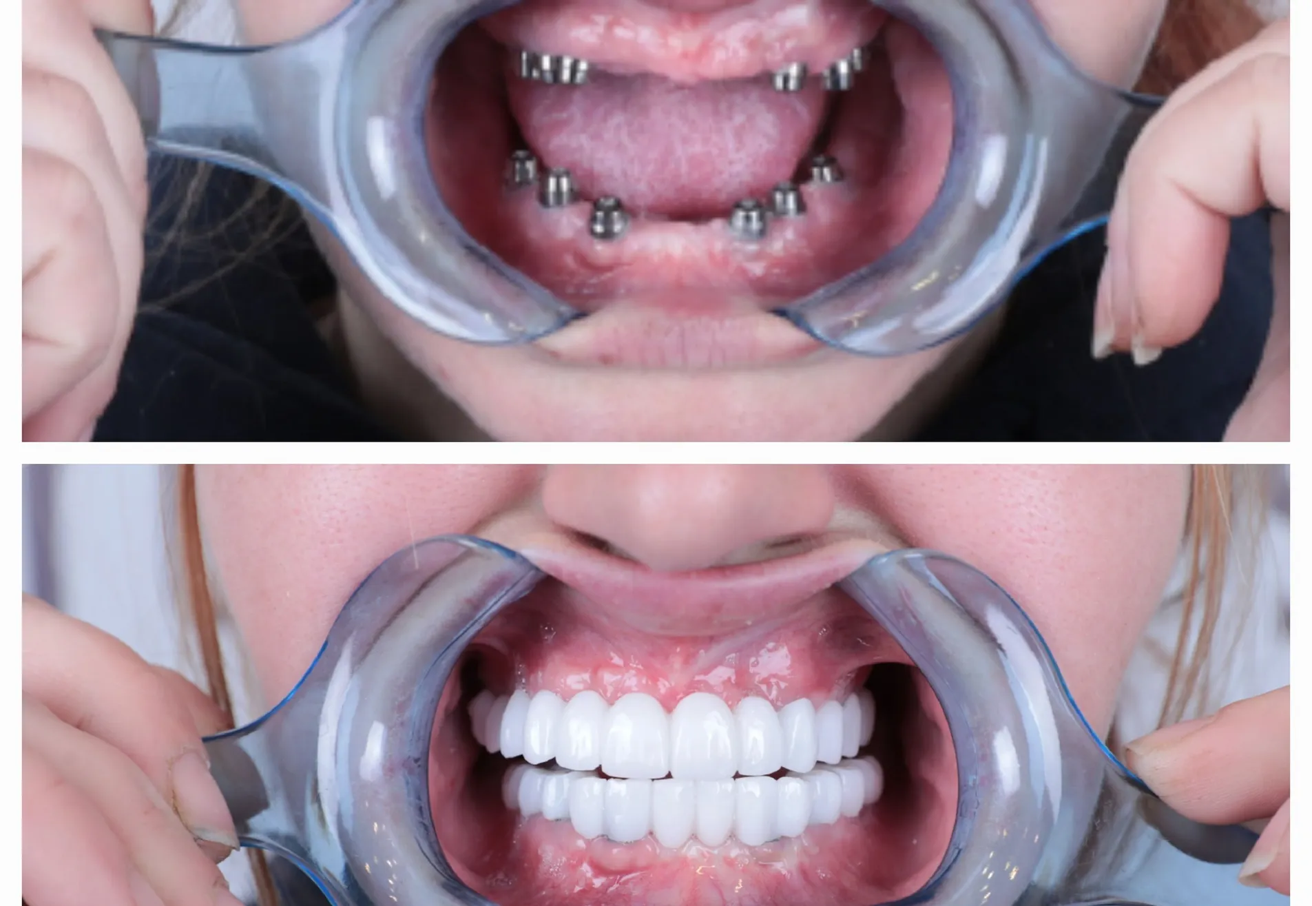 Anne implantaten en kronen all on 6 