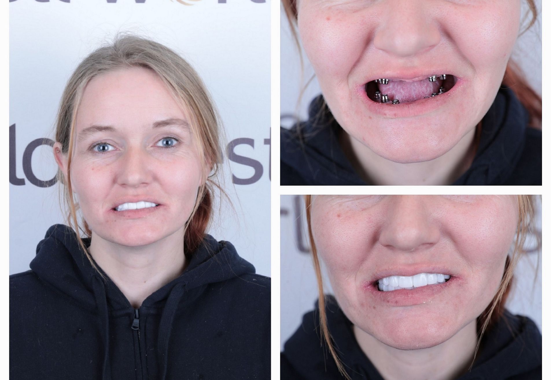 Anne implantaten en kronen all on 6 