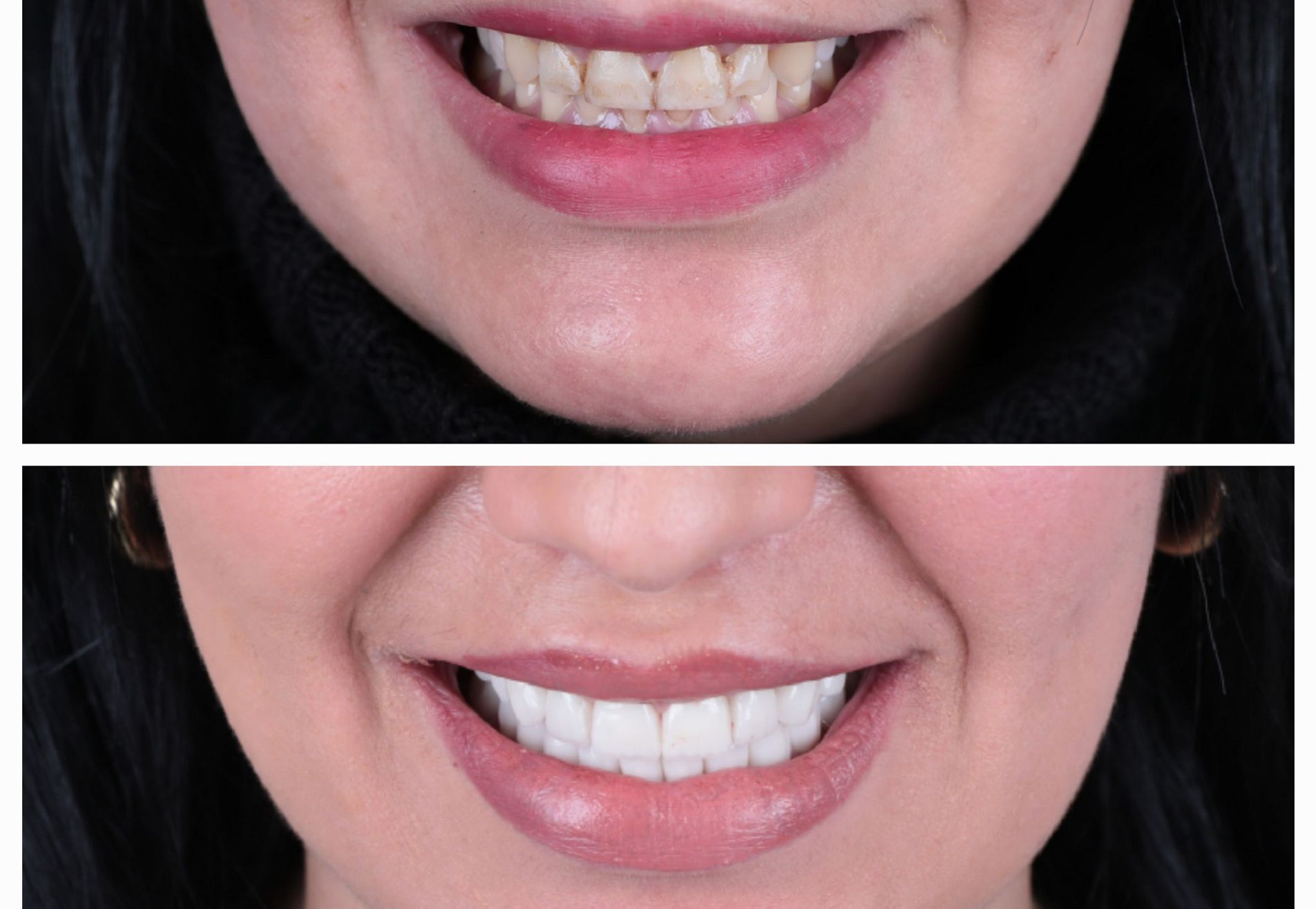 Francys kronen over mijn bestaande tanden heen