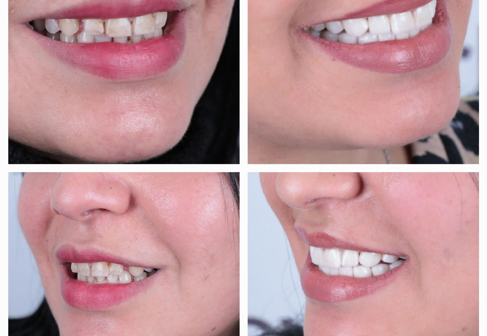 Francys kronen over mijn bestaande tanden heen