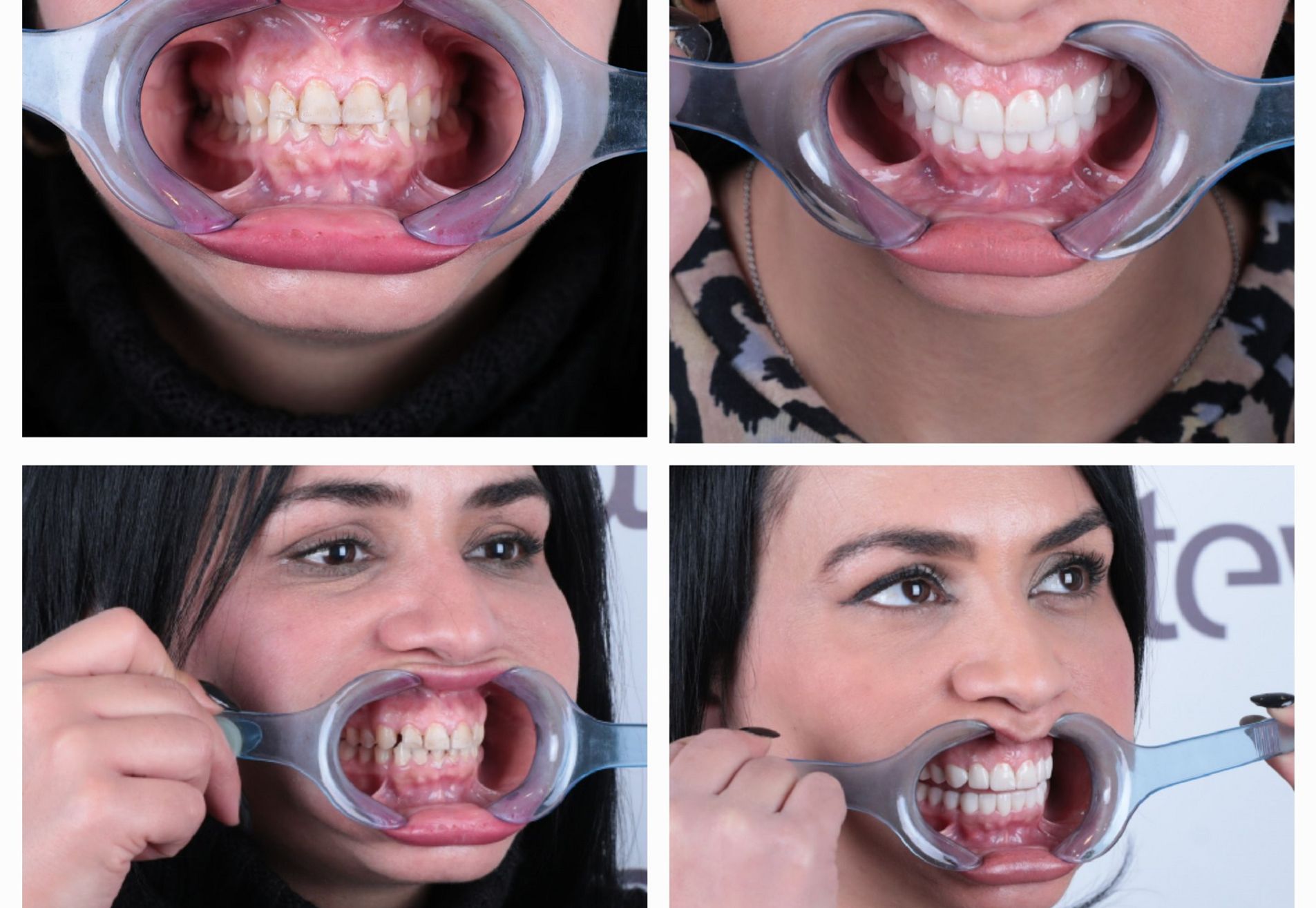 Francys kronen over mijn bestaande tanden heen