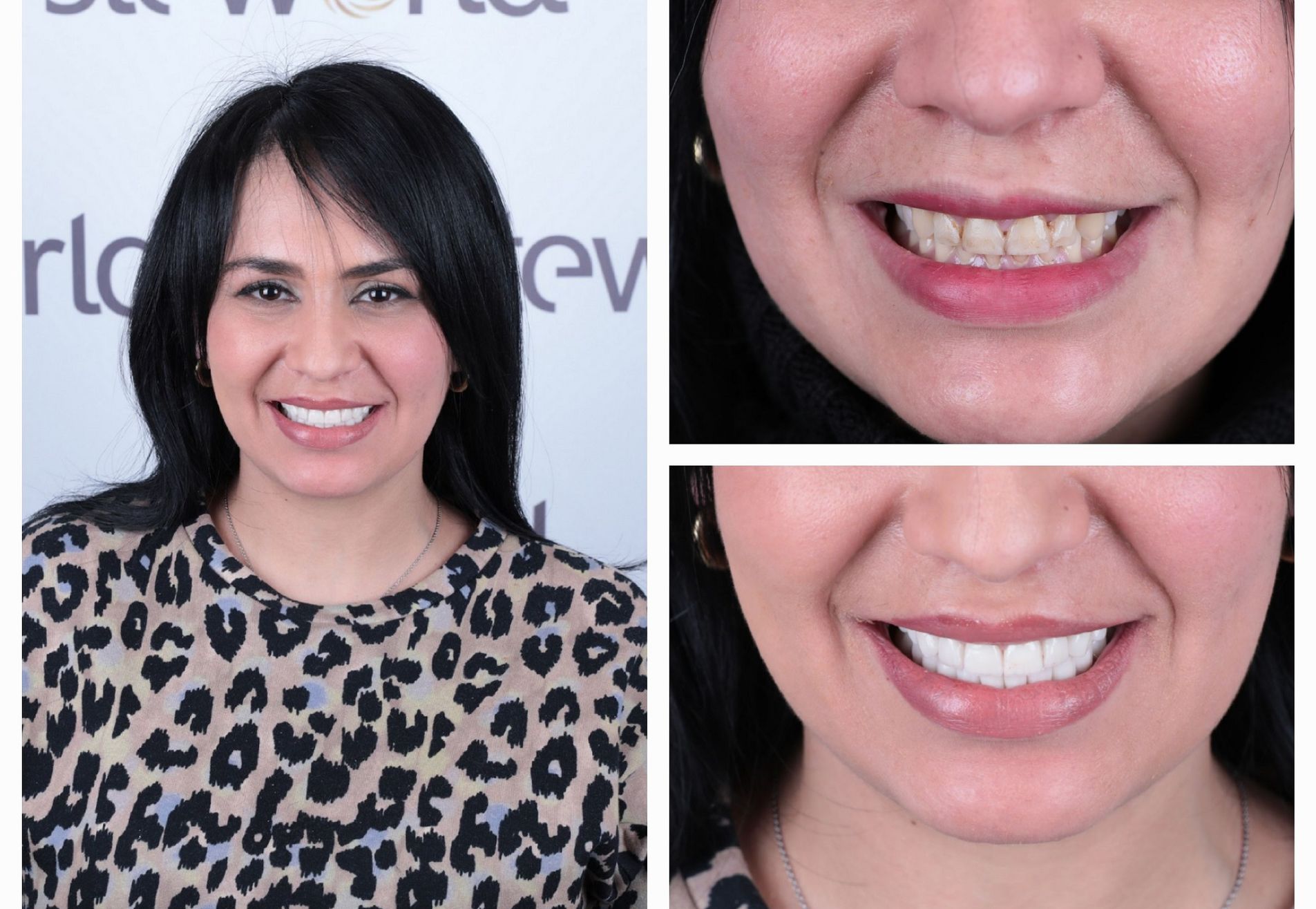 Francys kronen over mijn bestaande tanden heen