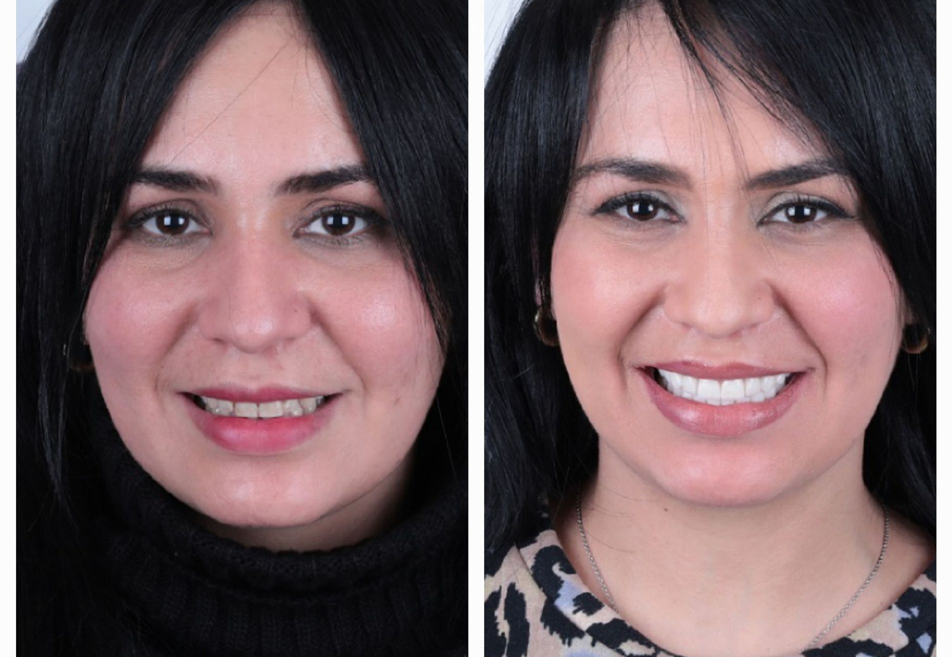 Francys kronen over mijn bestaande tanden heen