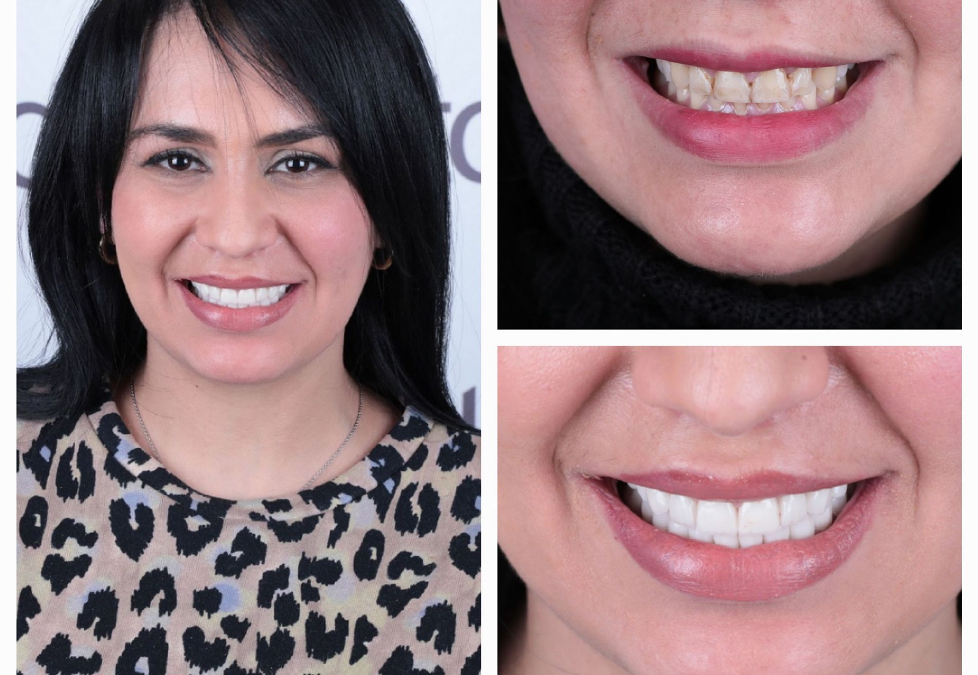 Francys kronen over mijn bestaande tanden heen