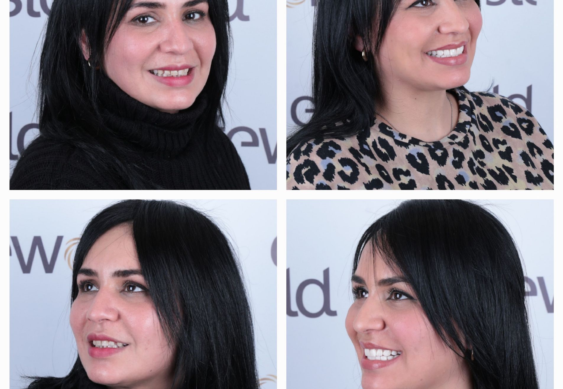 Francys kronen over mijn bestaande tanden heen