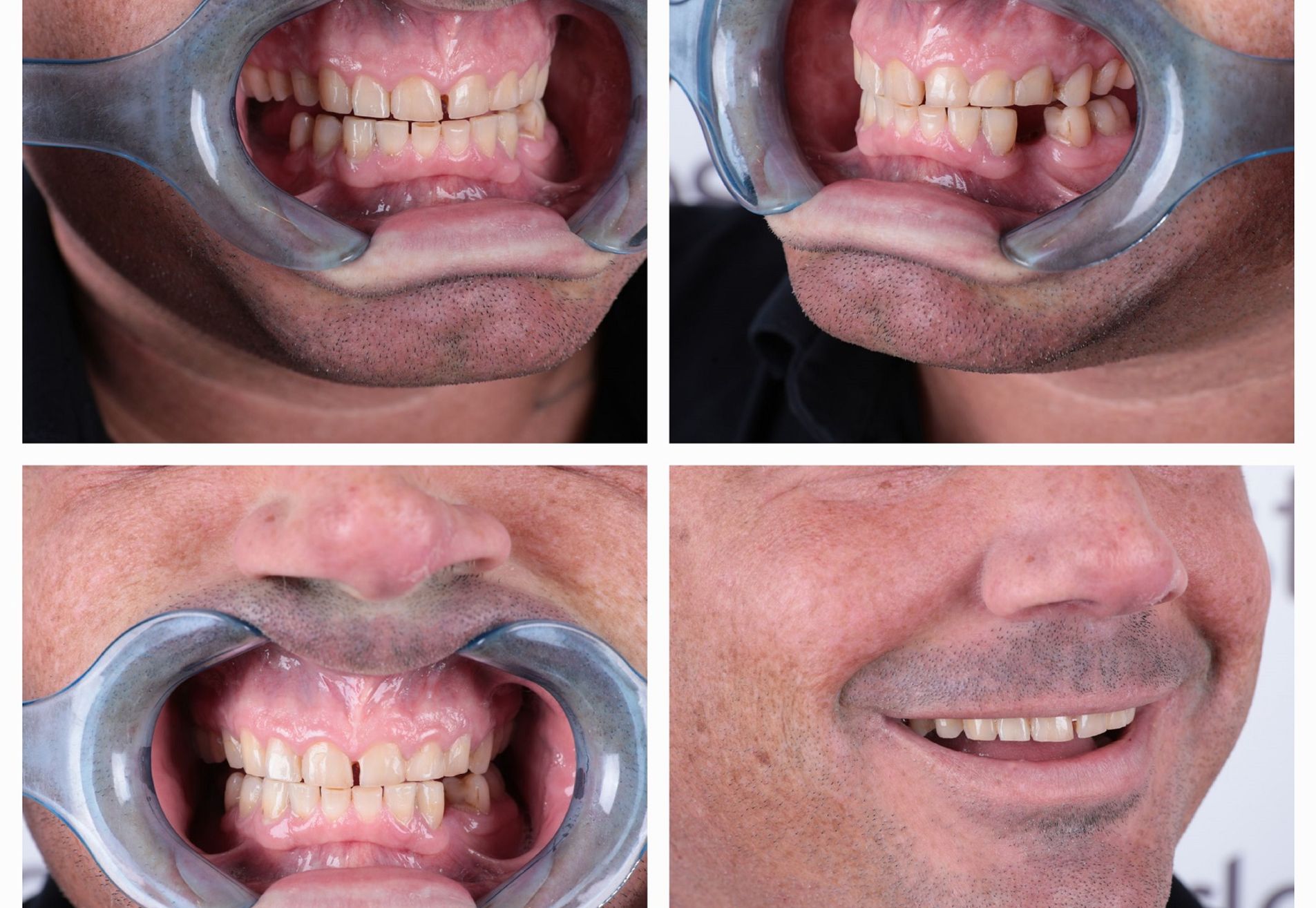 Brian, ik heb eindelijk die Hollywood Smile