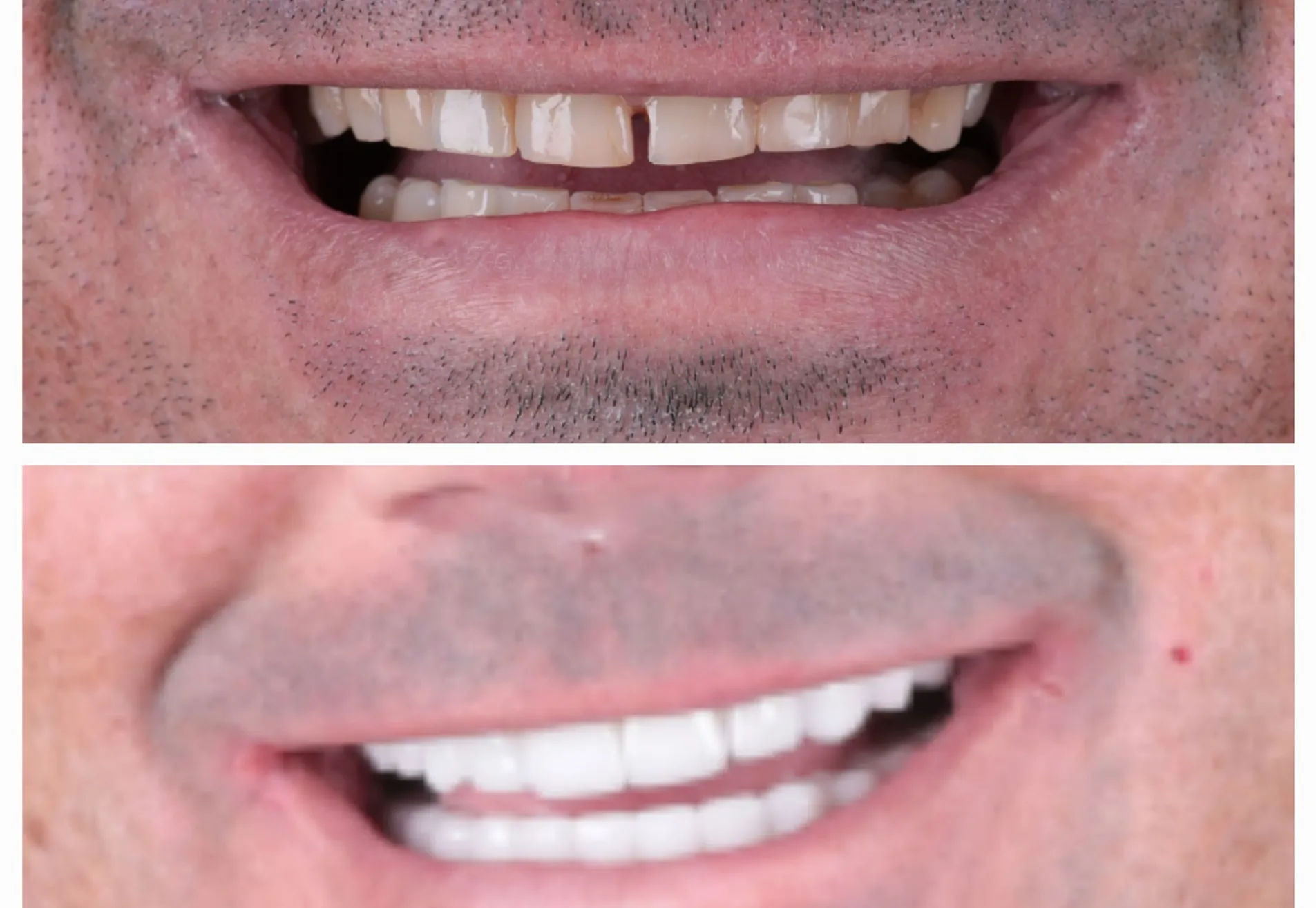 Brian, ik heb eindelijk die Hollywood Smile