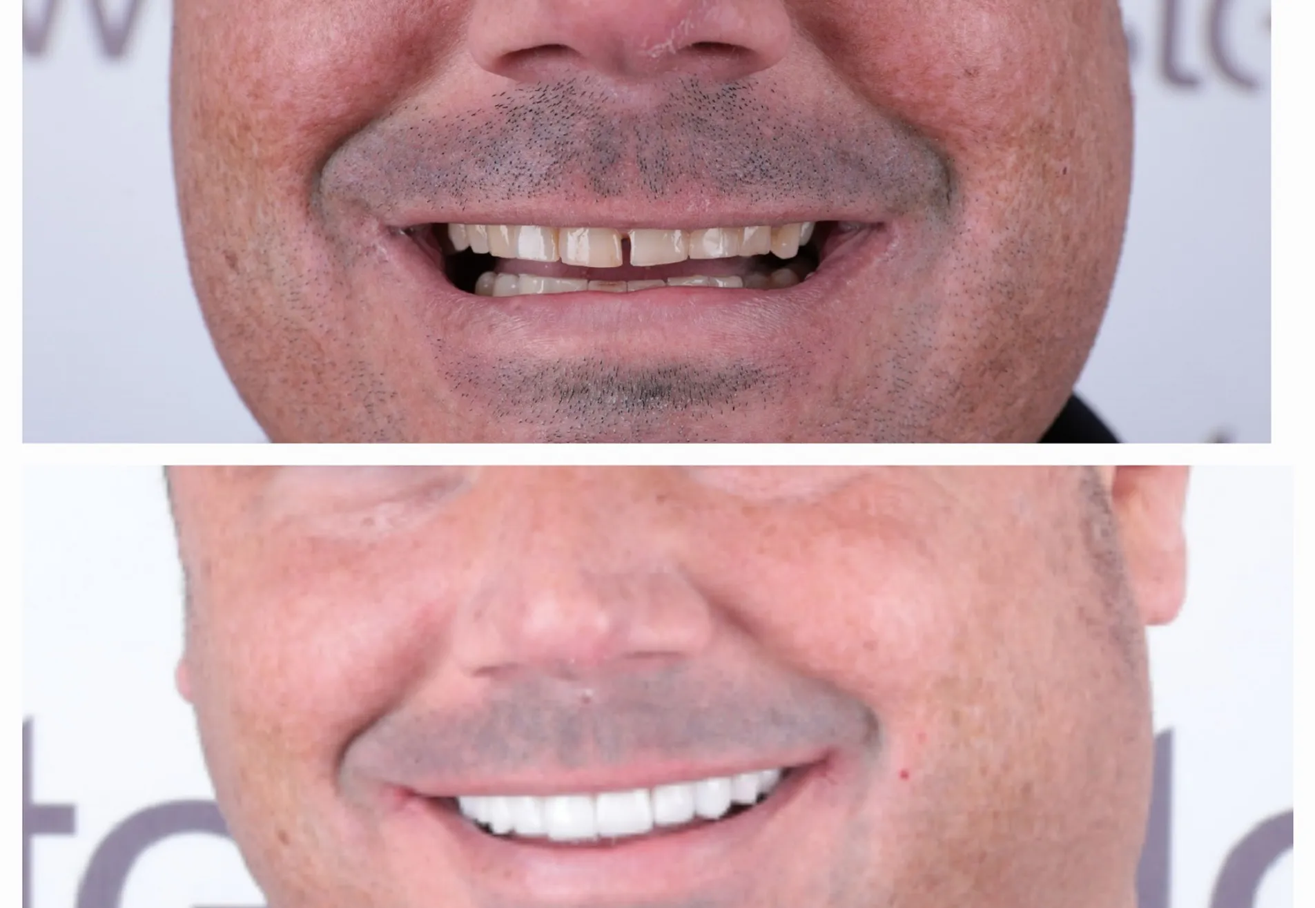Brian, ik heb eindelijk die Hollywood Smile