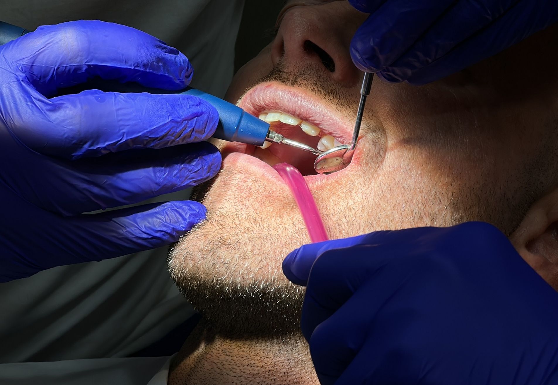 Na een geslaagde haartransplantatie nu Tanden