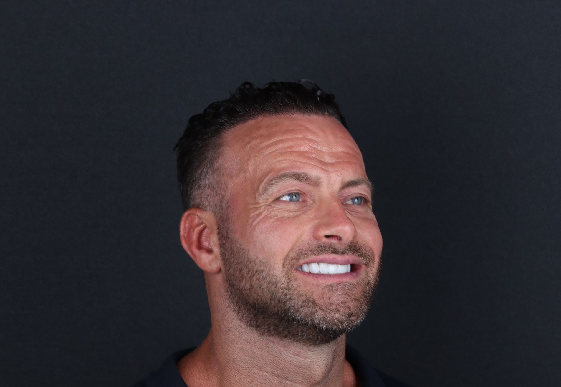 Na een geslaagde haartransplantatie nu Tanden