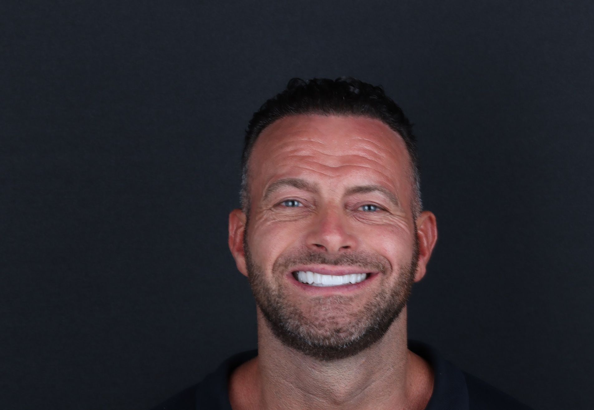 Na een geslaagde haartransplantatie nu Tanden