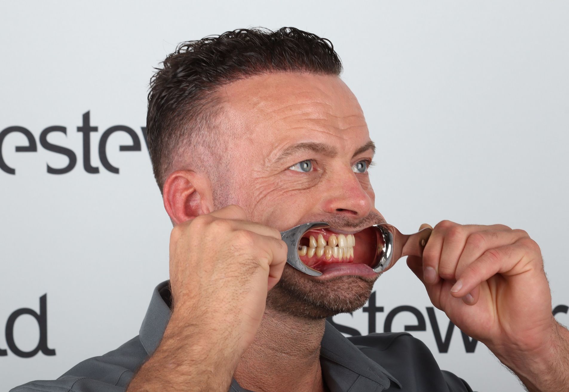 Na een geslaagde haartransplantatie nu Tanden