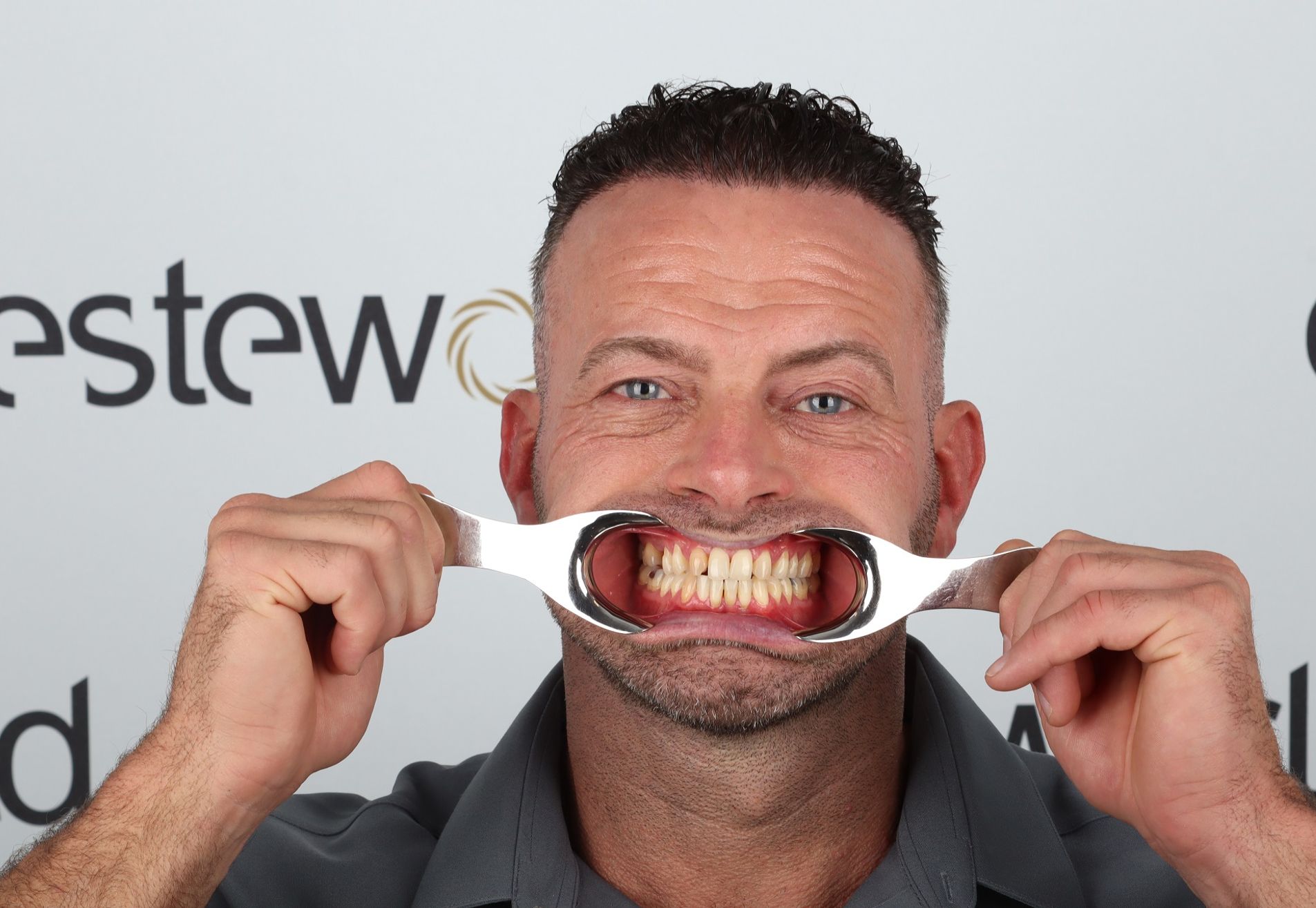 Na een geslaagde haartransplantatie nu Tanden