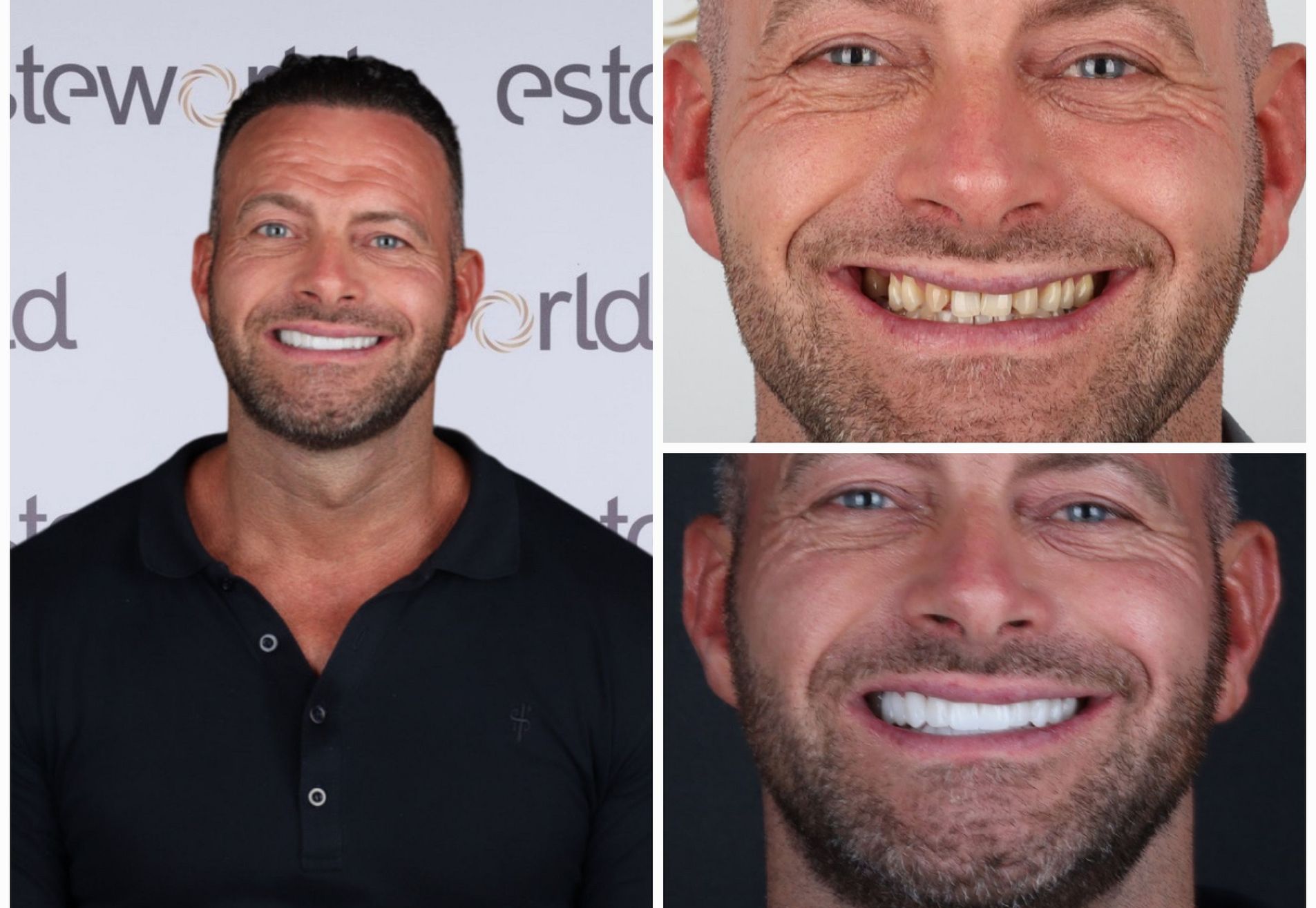 Na een geslaagde haartransplantatie nu Tanden