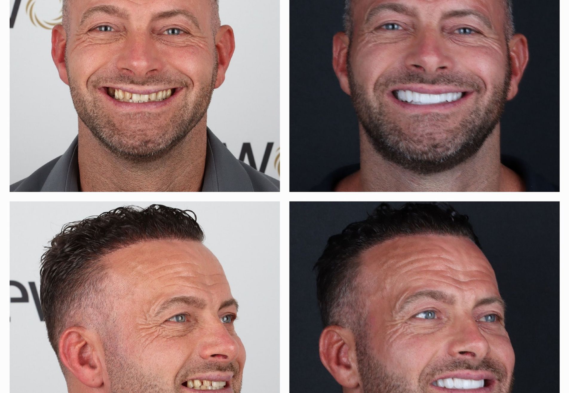 Na een geslaagde haartransplantatie nu Tanden