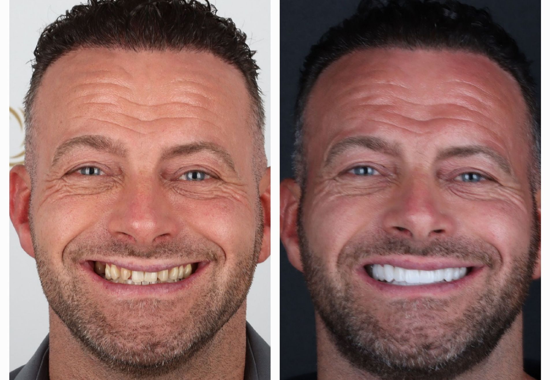 Na een geslaagde haartransplantatie nu Tanden