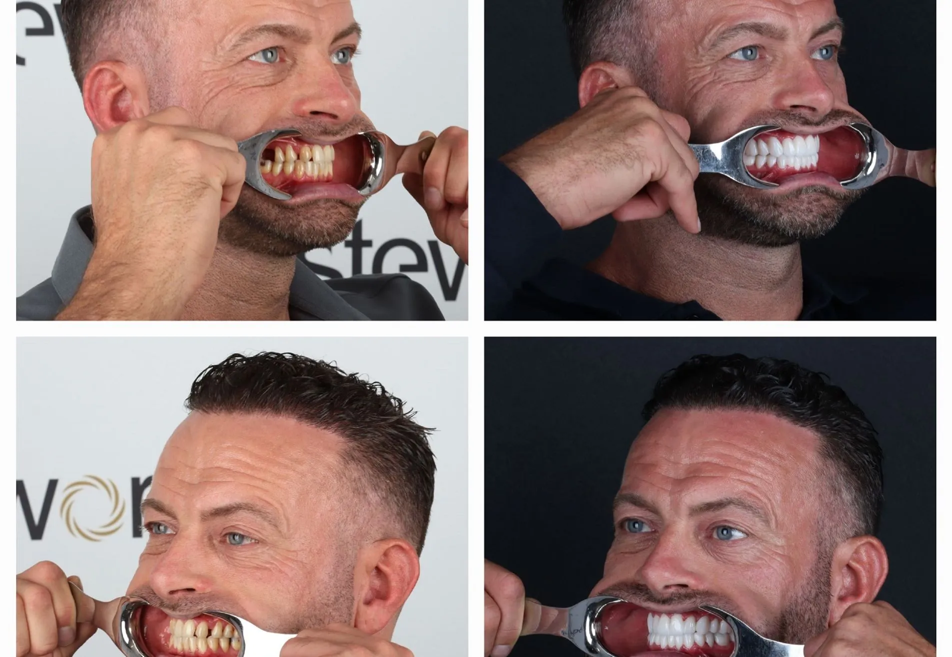 Na een geslaagde haartransplantatie nu Tanden