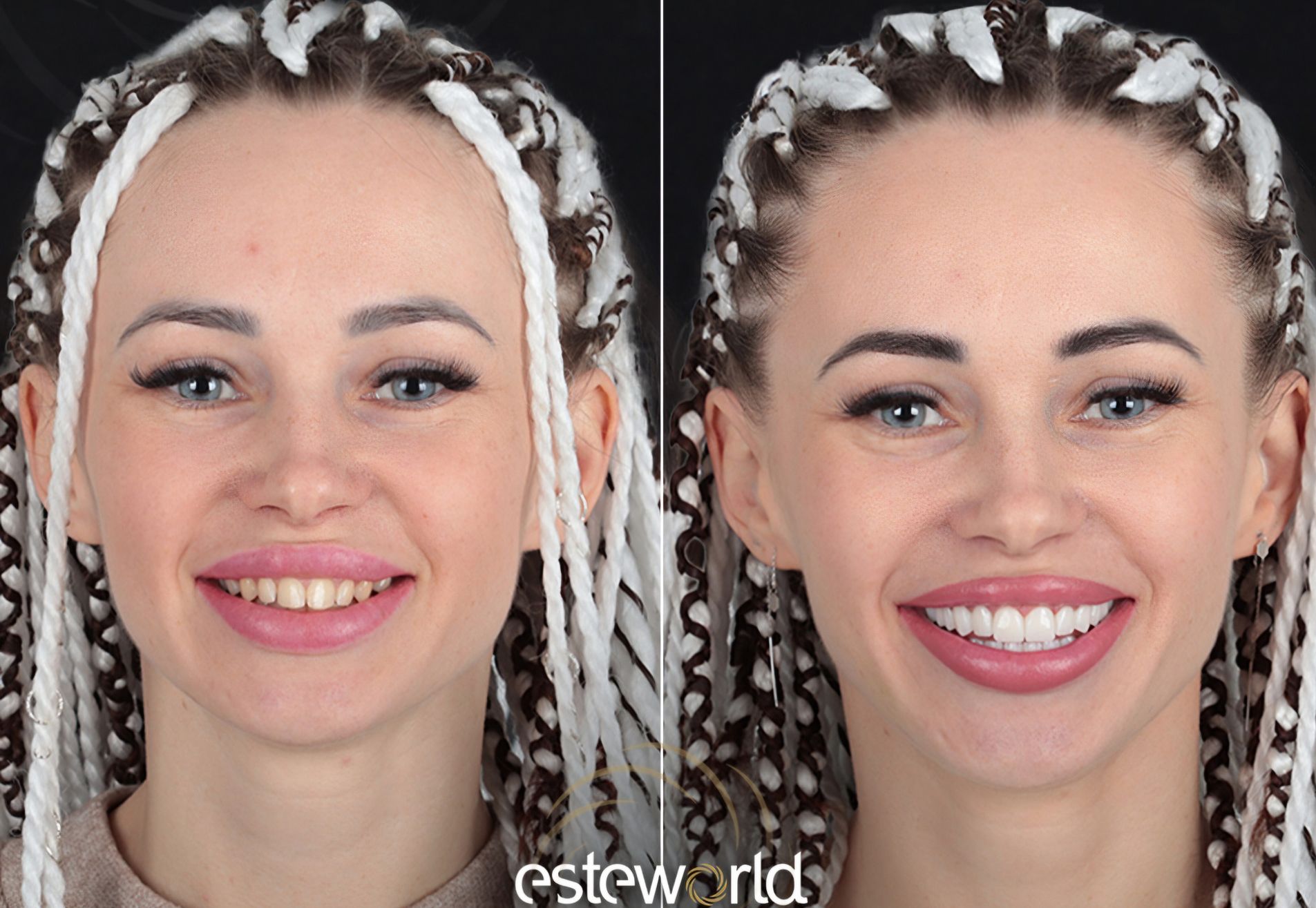 Jody, zelfvertrouwen door mijn smile