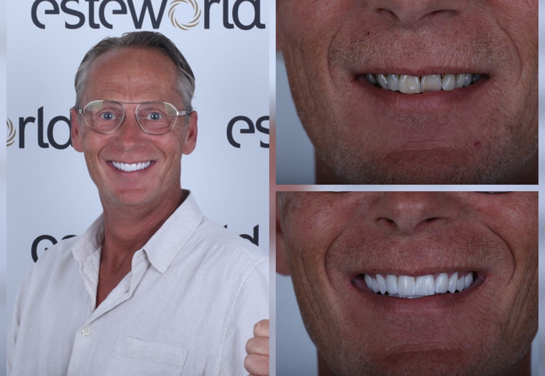 Alexander, zwak gebit en jaren gerookt