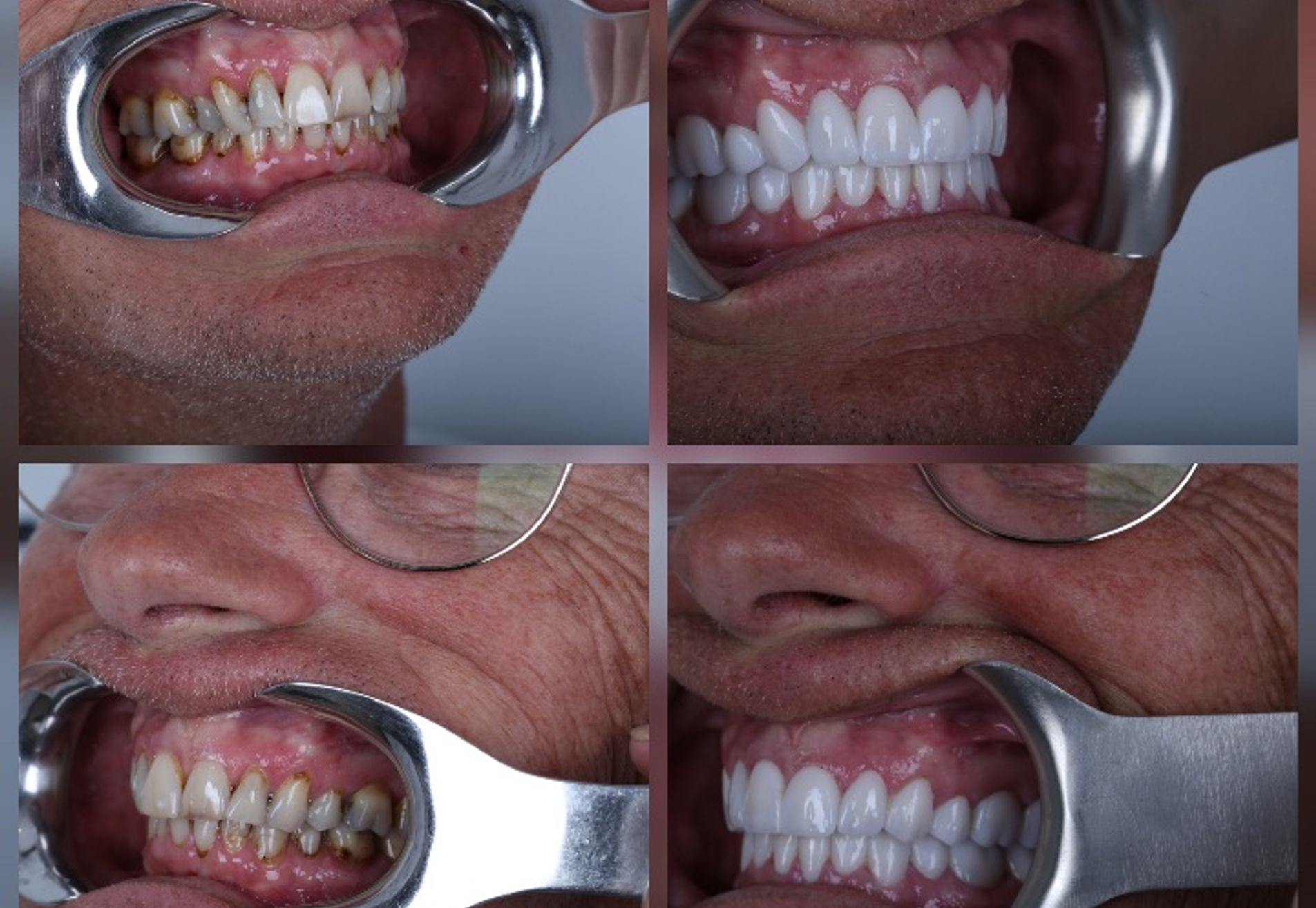 Alexander, zwak gebit en jaren gerookt