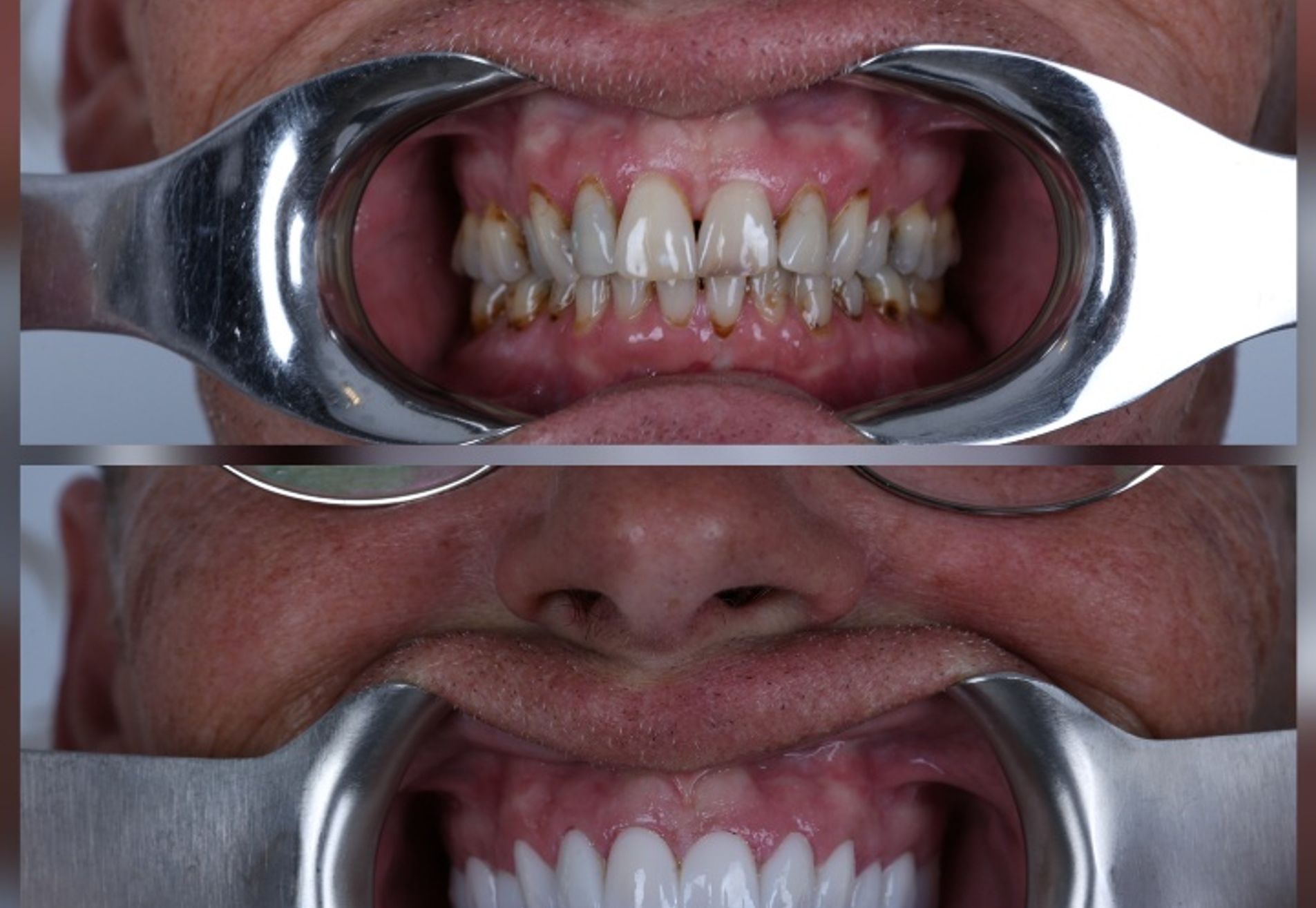 Alexander, zwak gebit en jaren gerookt