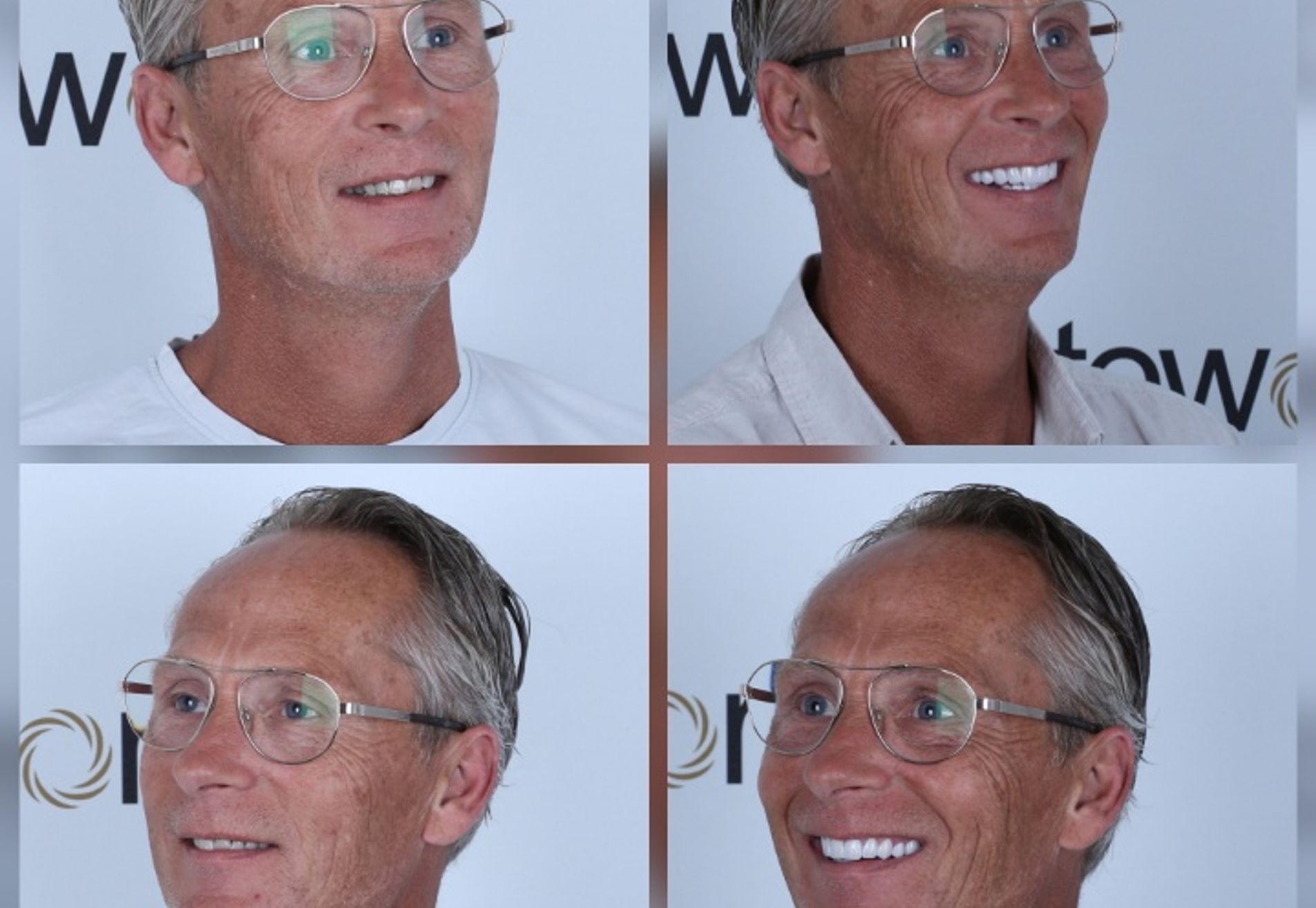 Alexander, zwak gebit en jaren gerookt